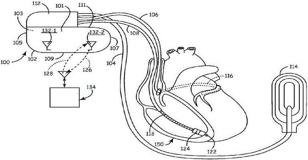 Implantable medical equipment