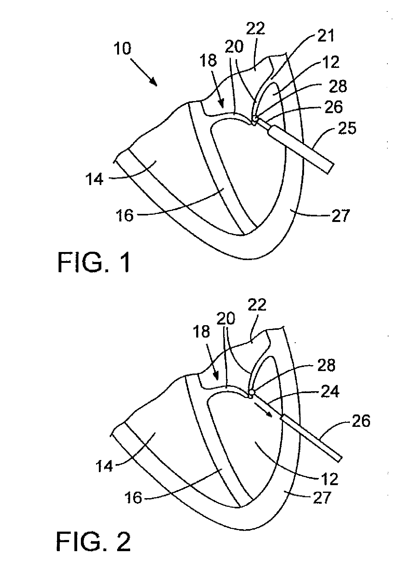 Method and apparatus for repairing or replacing chordae tendinae