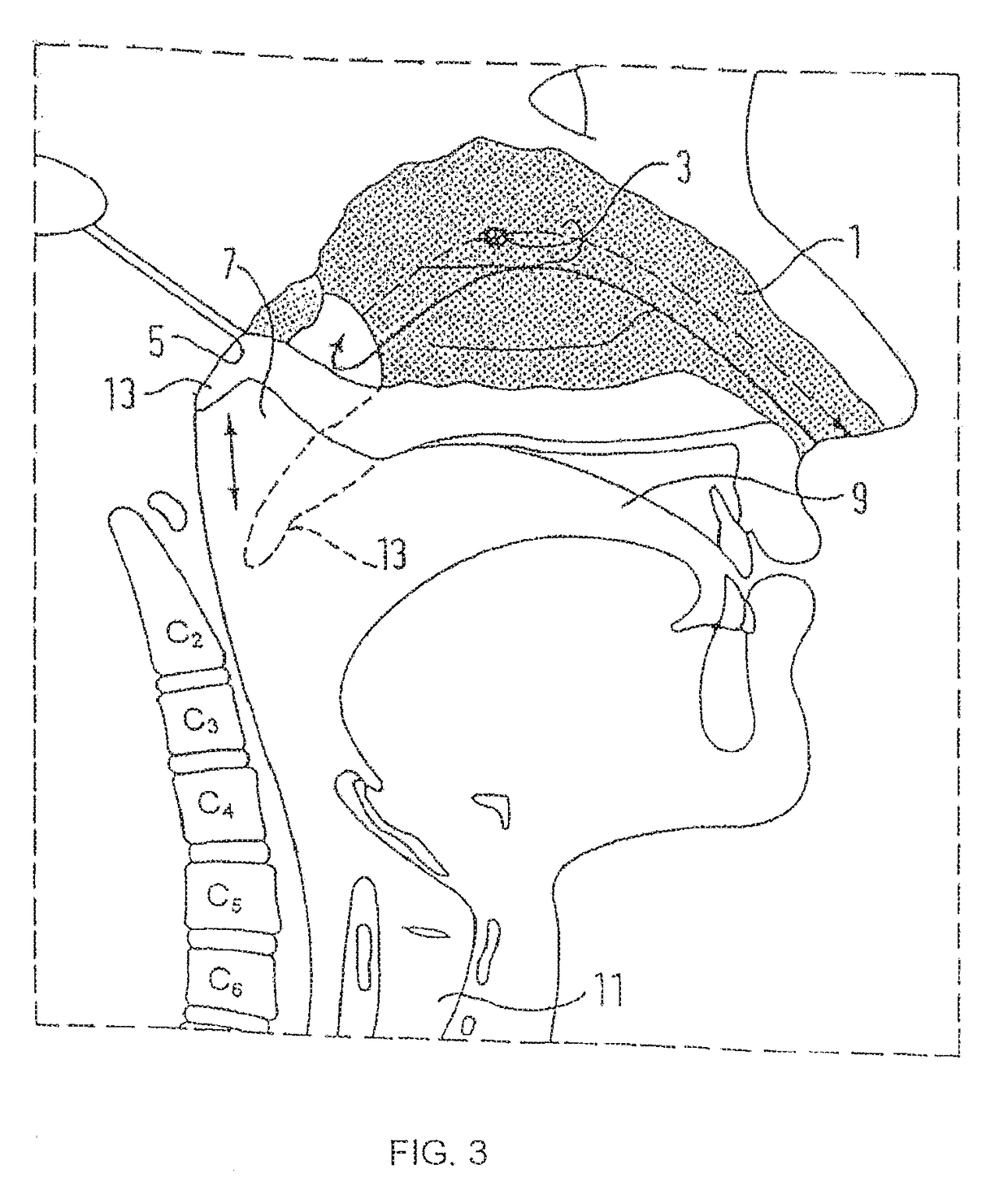 Nasal delivery