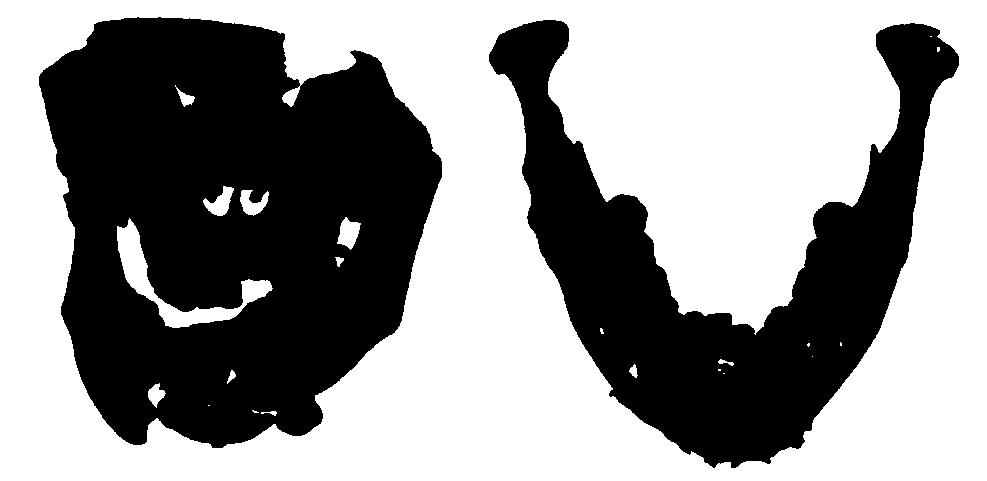 A method of complementing diseased bone to obtain bone expected reference model