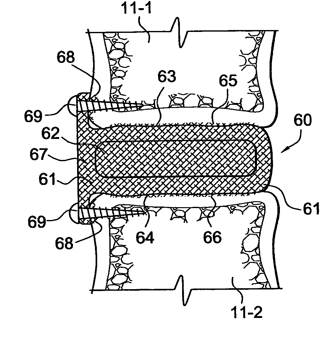 Intervertebral disc replacement