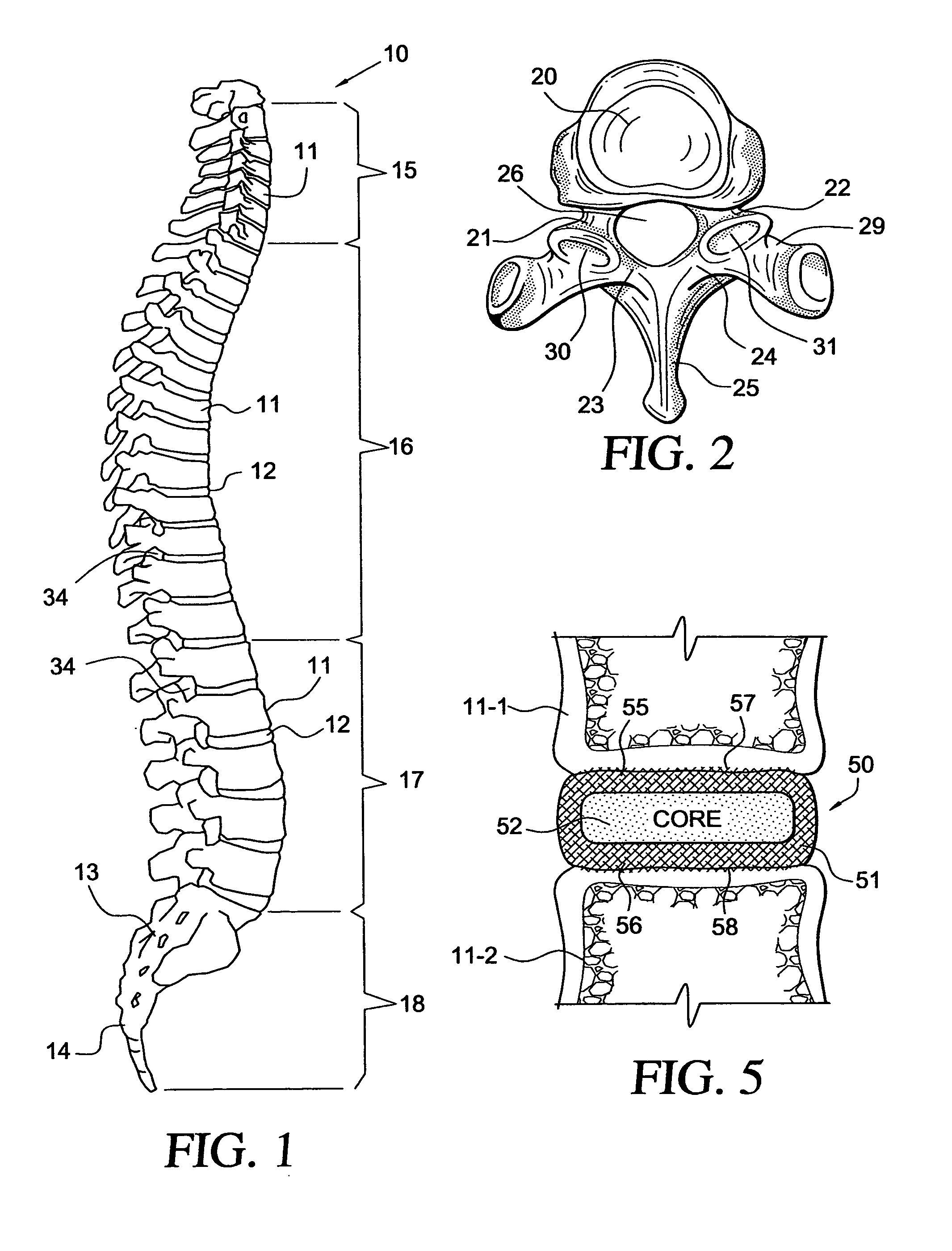 Intervertebral disc replacement