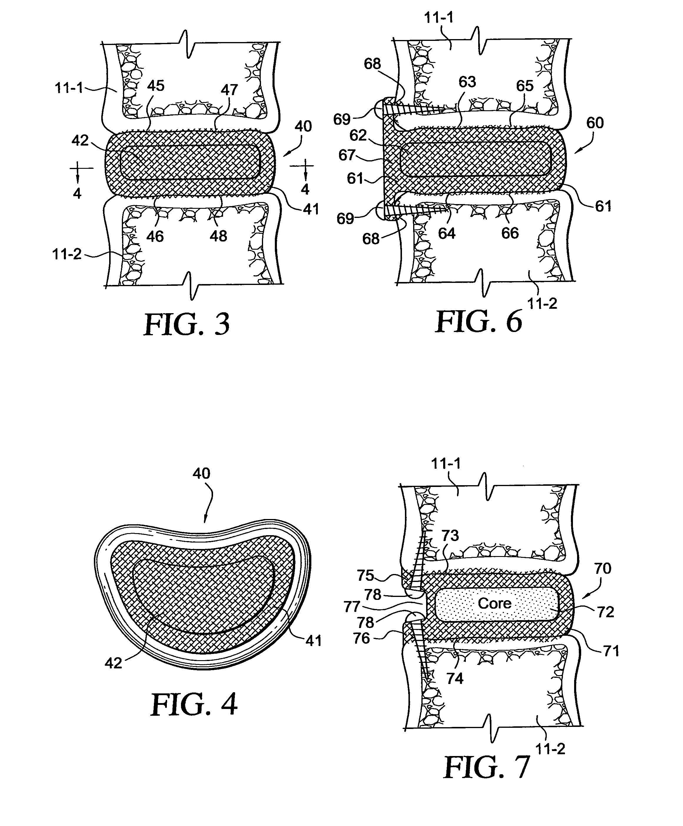 Intervertebral disc replacement