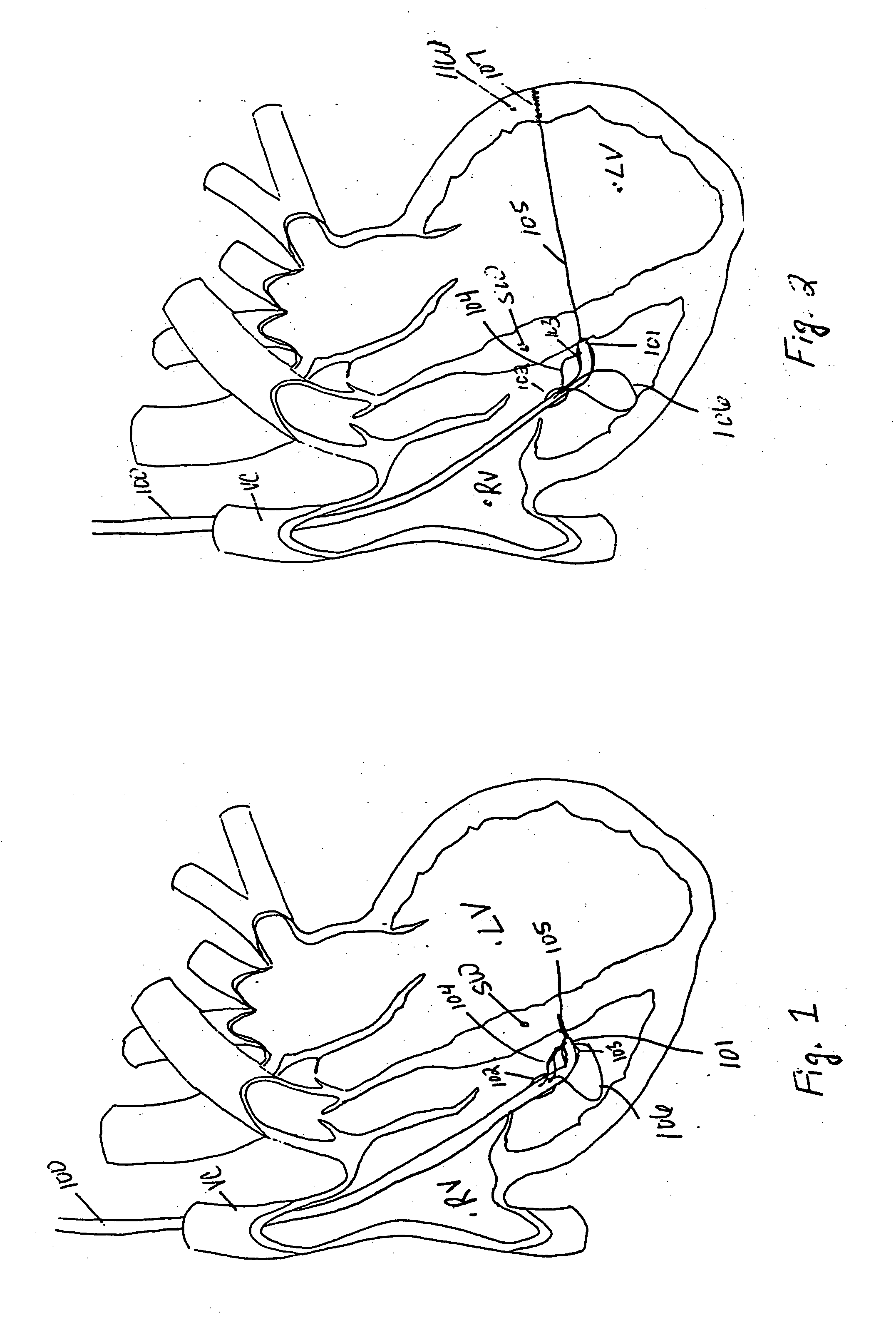 Endovascular splinting devices and methods