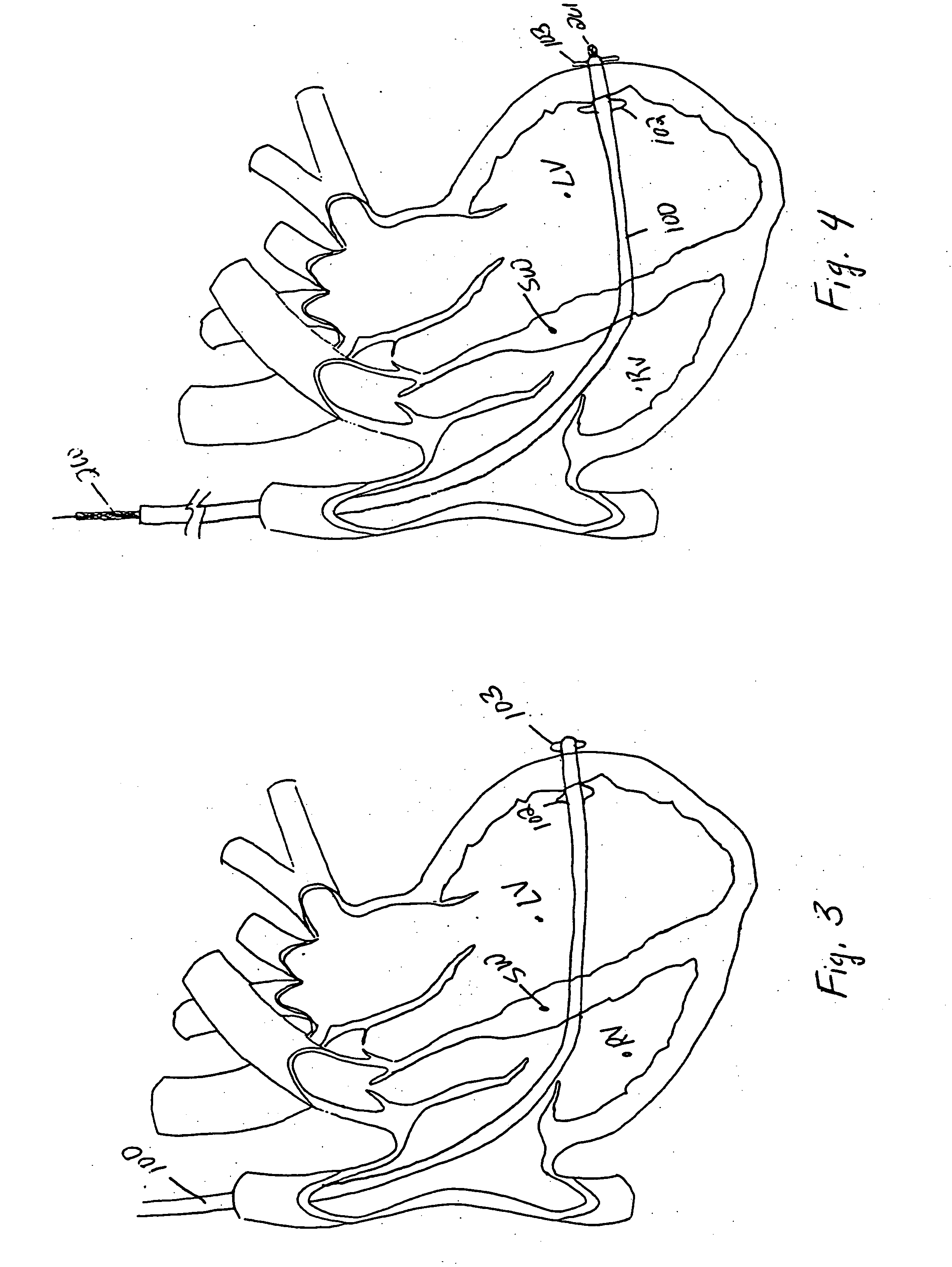 Endovascular splinting devices and methods