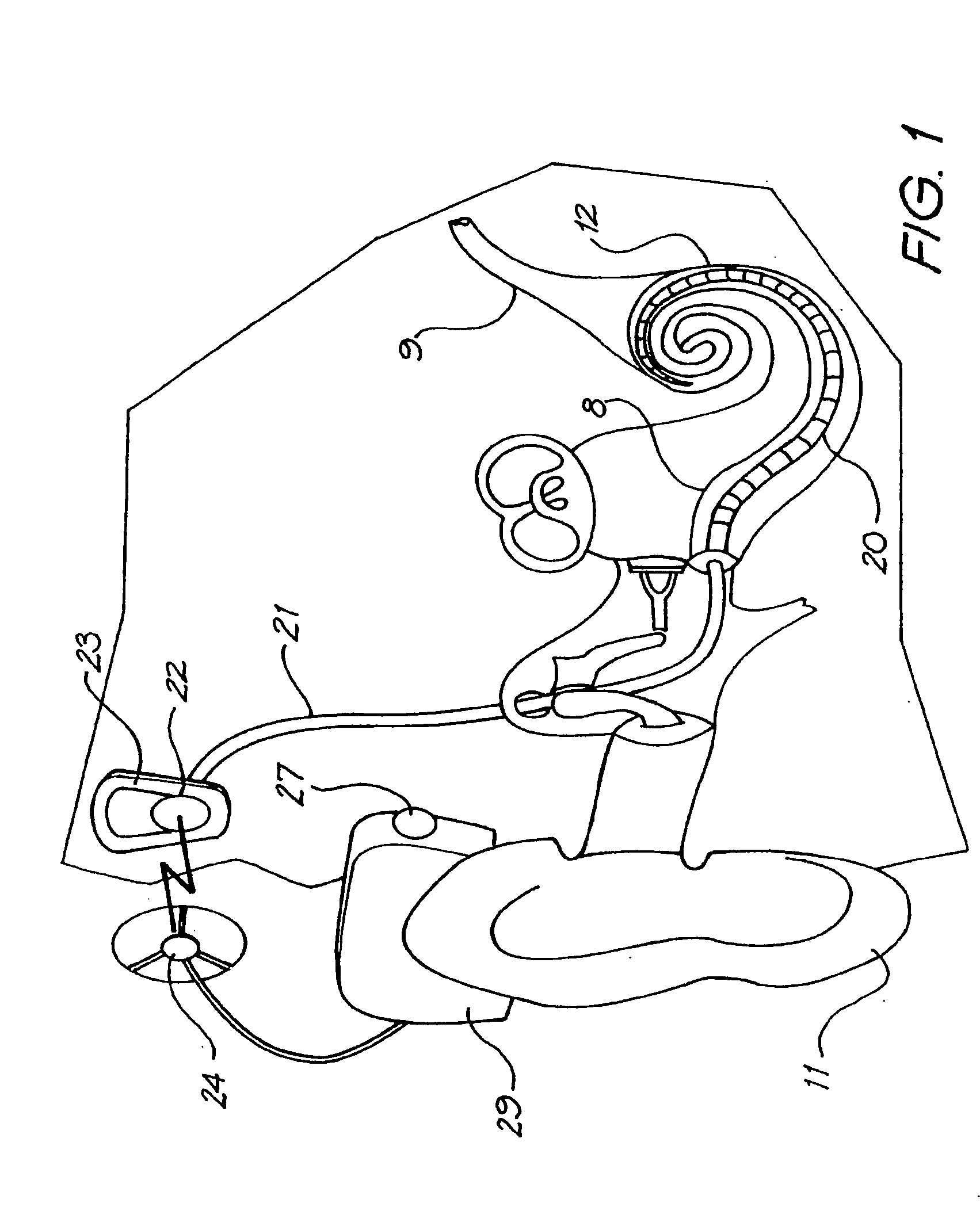 Cochlear implant electrode array