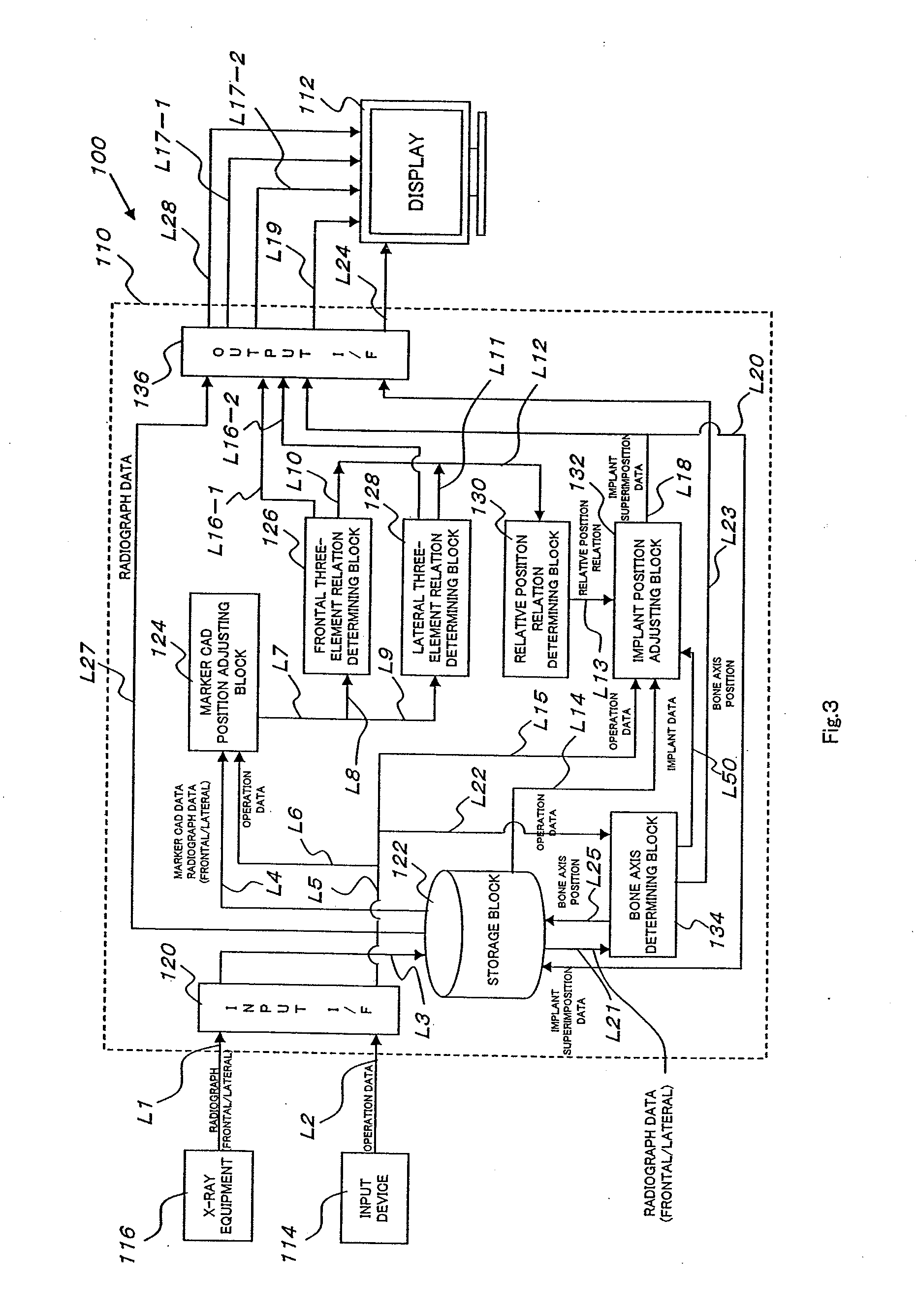 Artificial joint replacement assisting device, artificial joint replacement assisting method using same, and assisting system