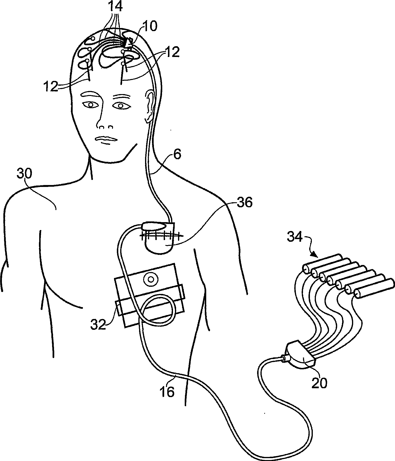 Apparatus for fluid delivery with implantable housing openable for providing access to a fluid connector