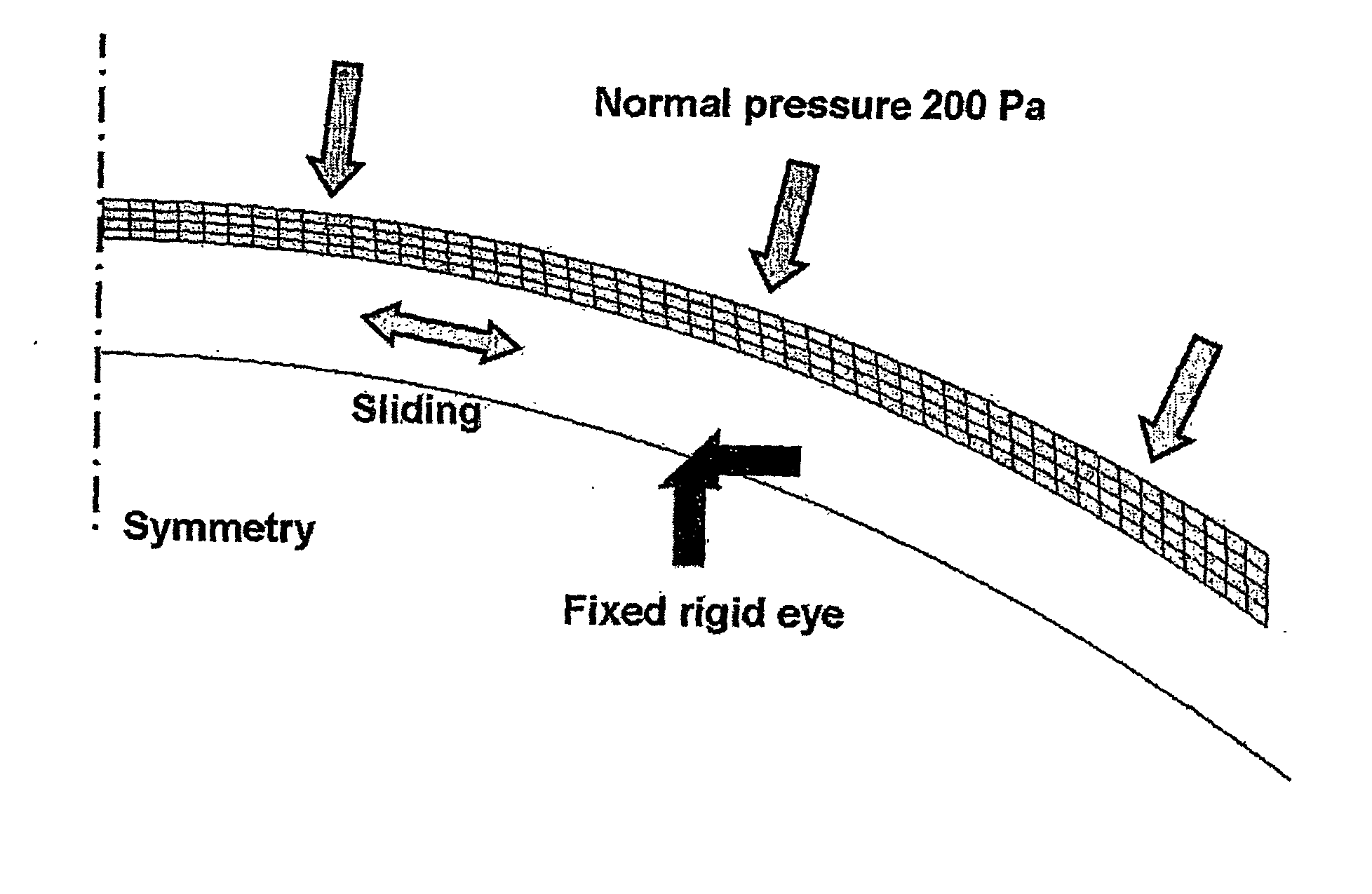 Soft Lens Orthokeratology