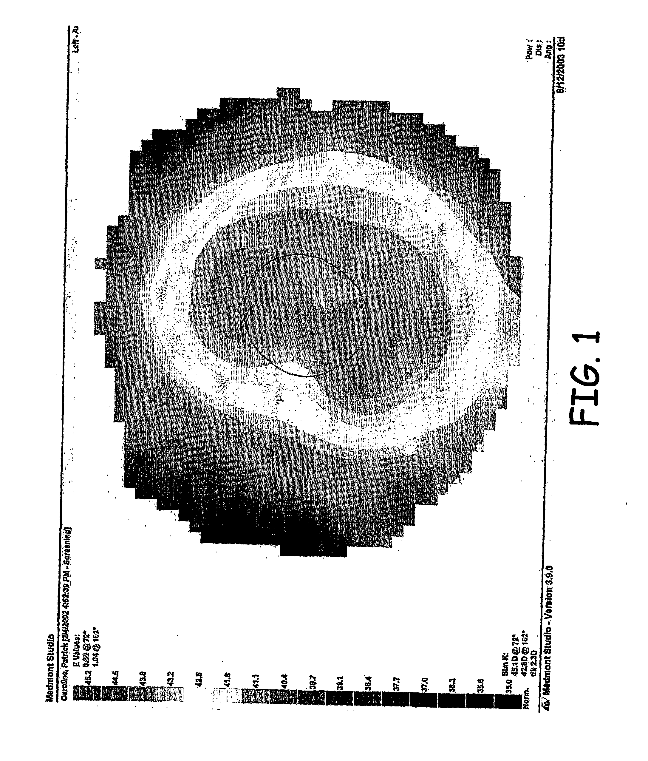 Soft Lens Orthokeratology