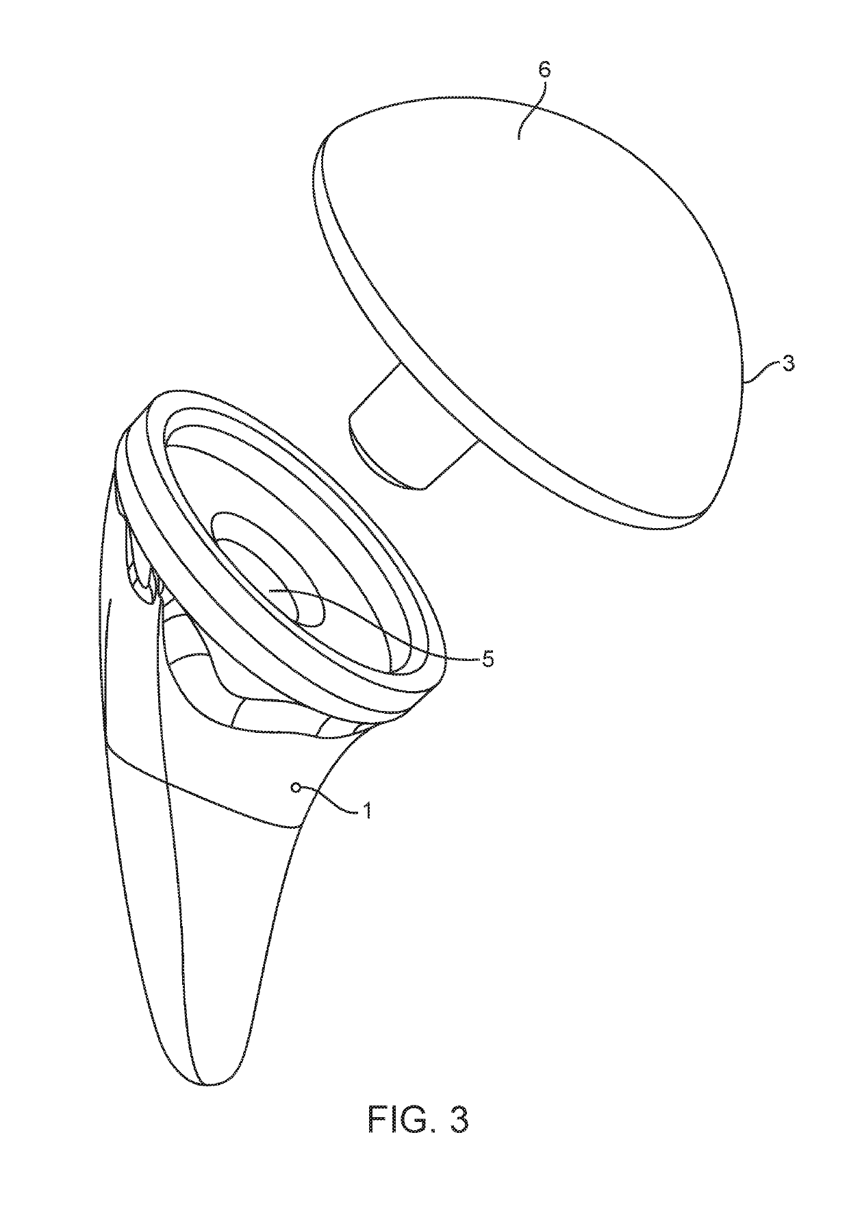 Shoulder arthroplasty implant system