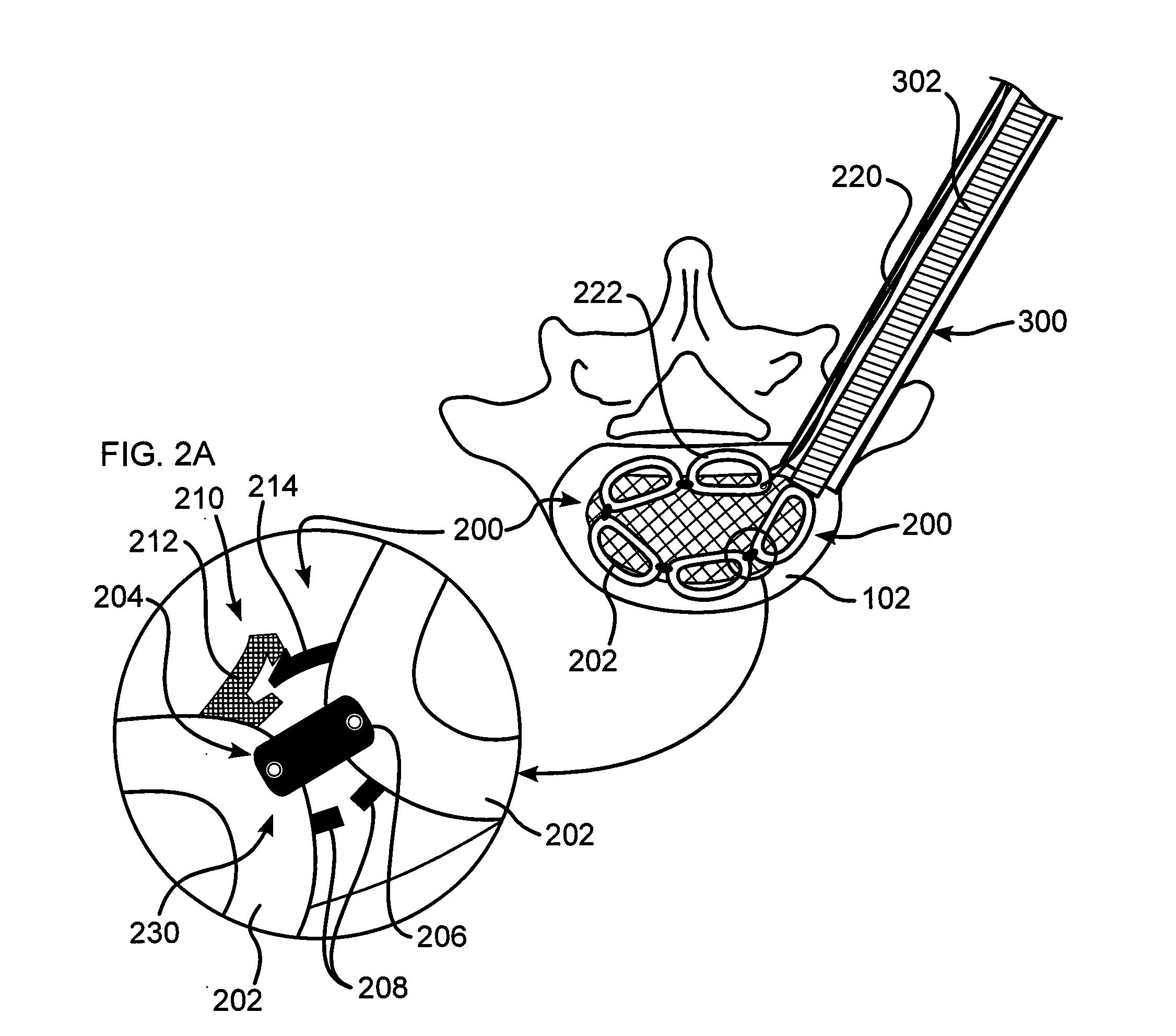 Intervertebral Implant