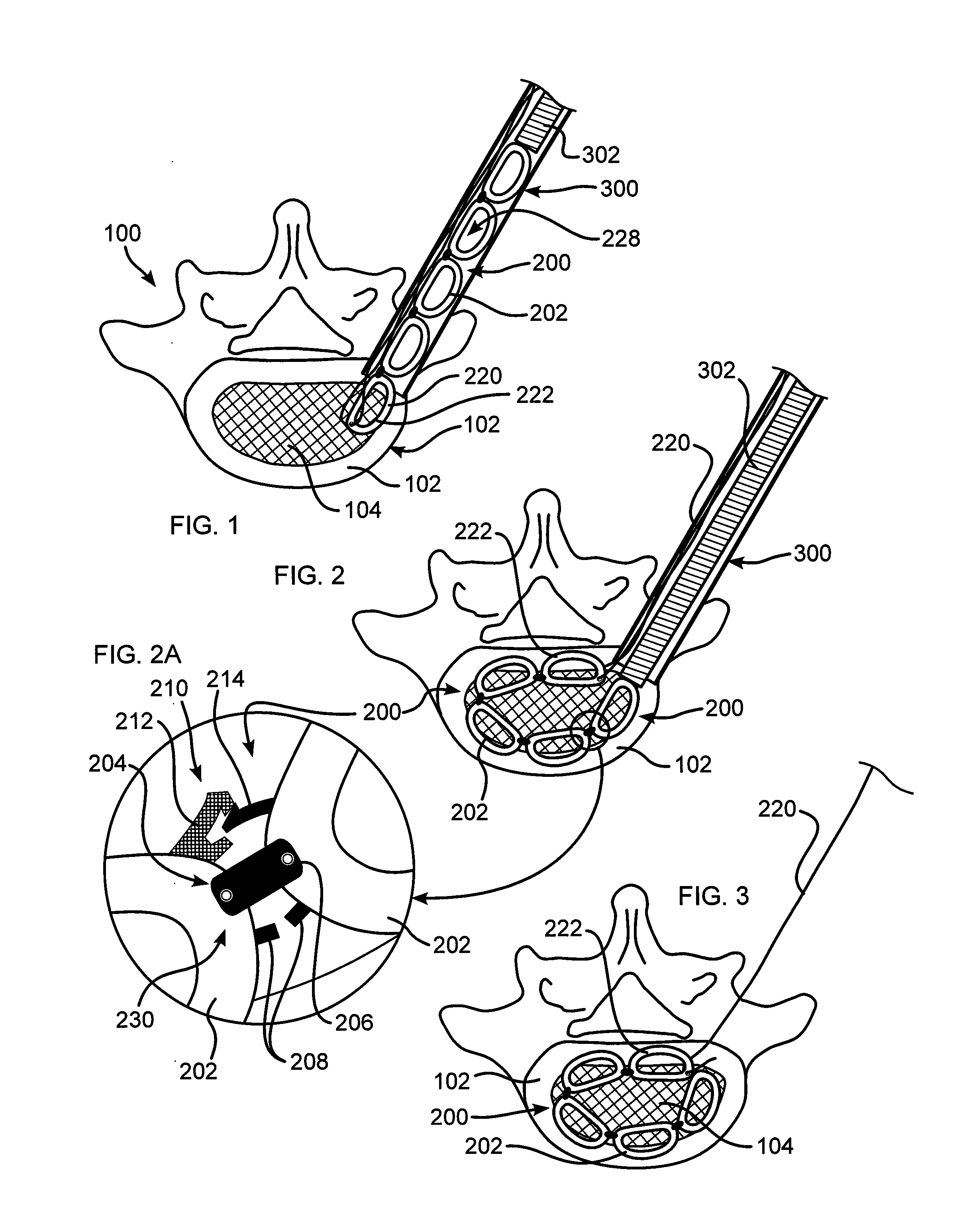 Intervertebral Implant