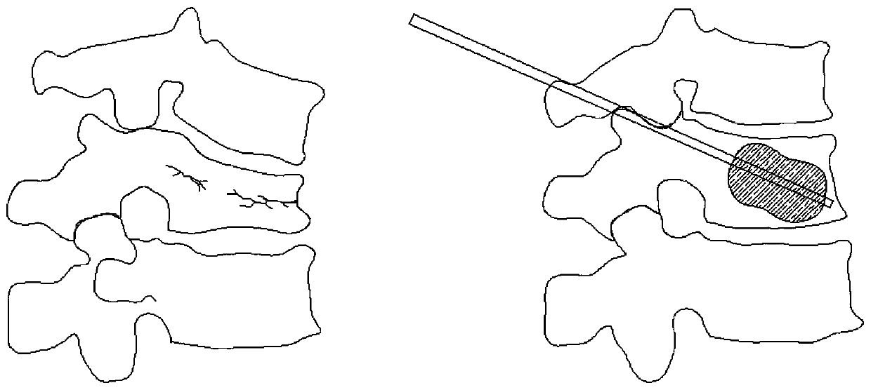 Surface-drug-loading vertebroplasty dilatation balloon and preparation method thereof