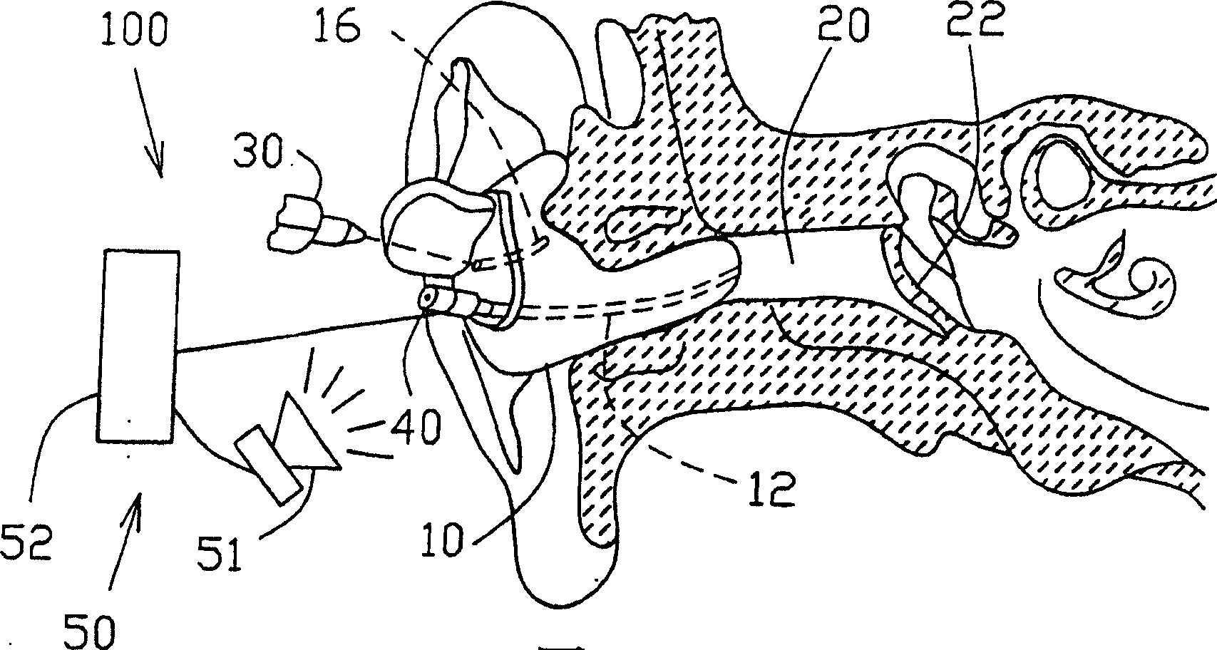 Method and apparatus for determining in situ the acoustic seal provided by an in-ear device