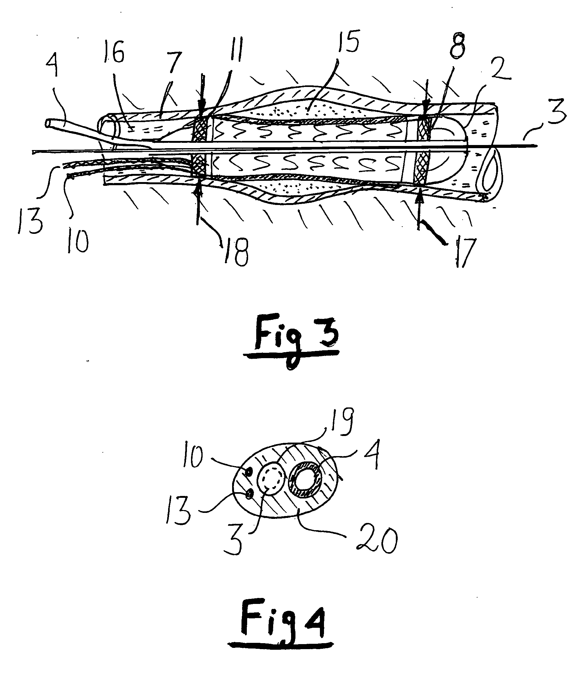 Lumen diameter and stent apposition sensing