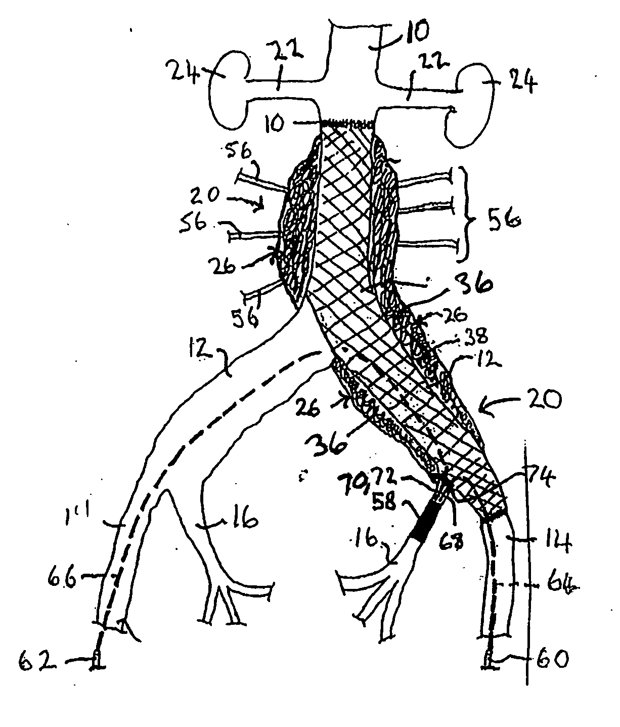 Endovascular treatment devices and methods
