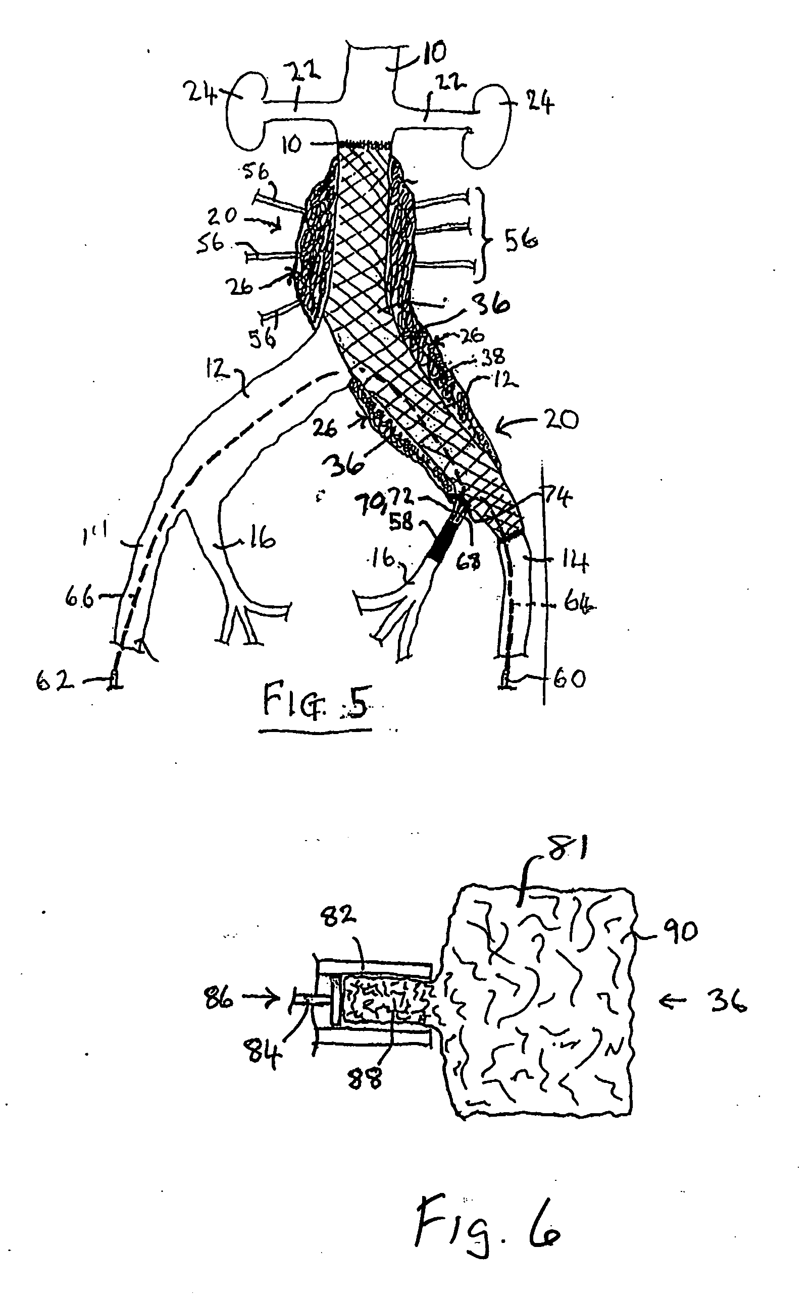 Endovascular treatment devices and methods
