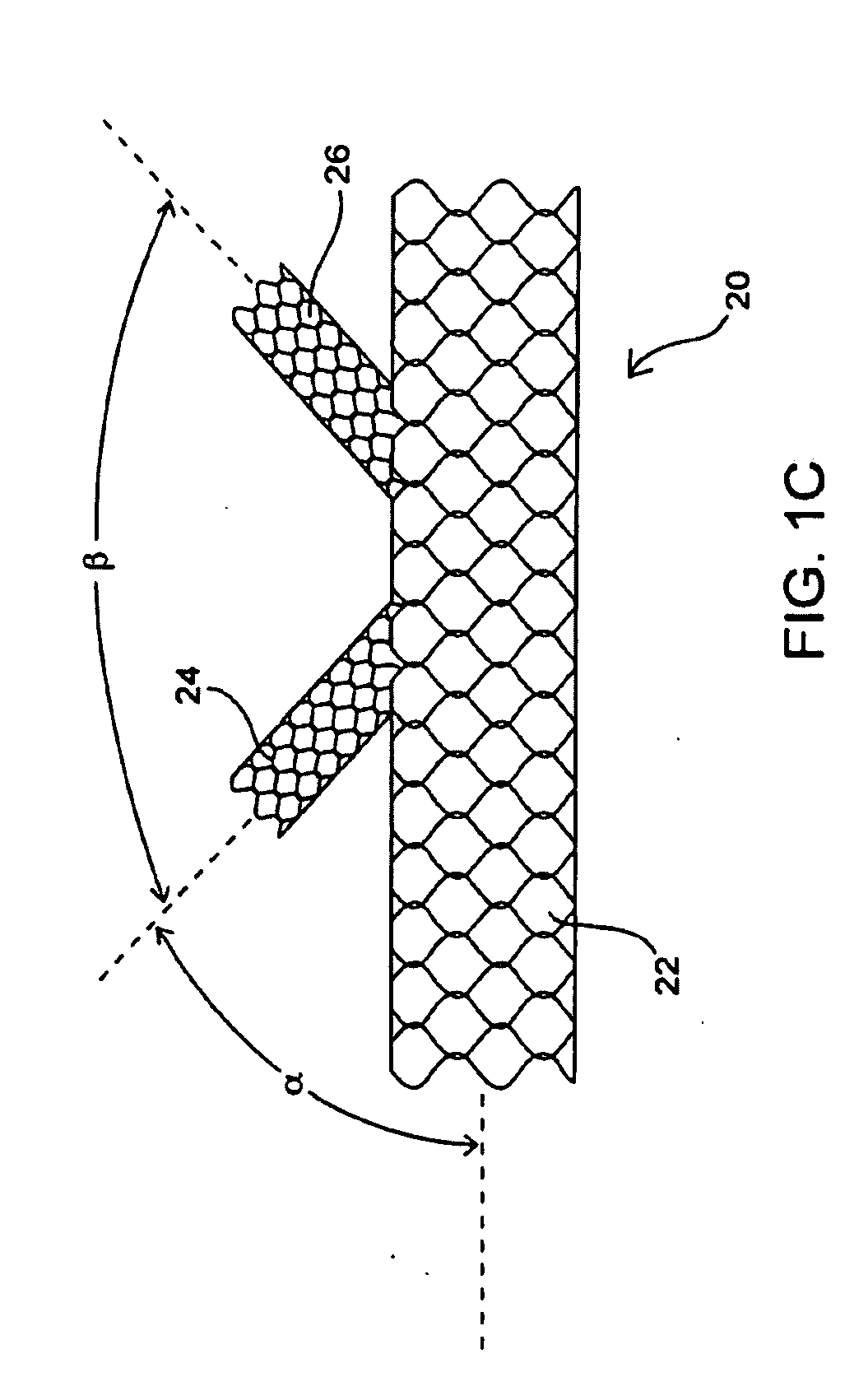 Apparatus and method for deploying an implantable device within the body