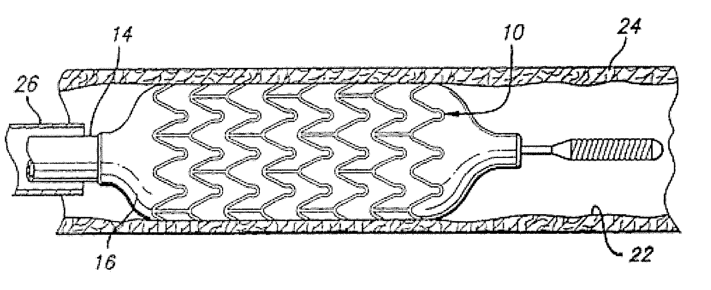 Radiopaque markers comprising binary alloys of titanium