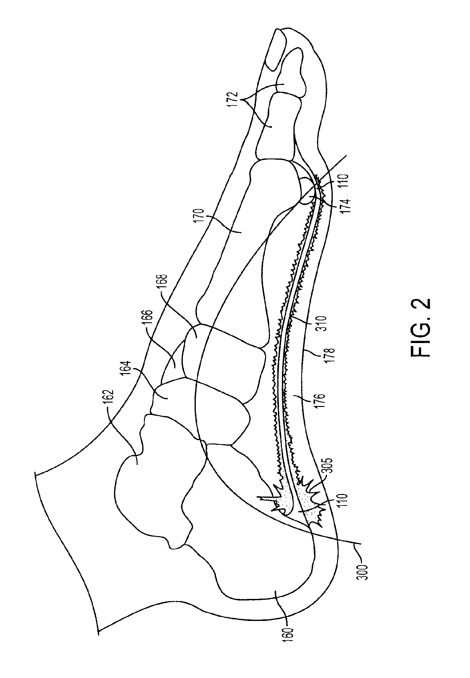 System for treatment of plantar fasciitis