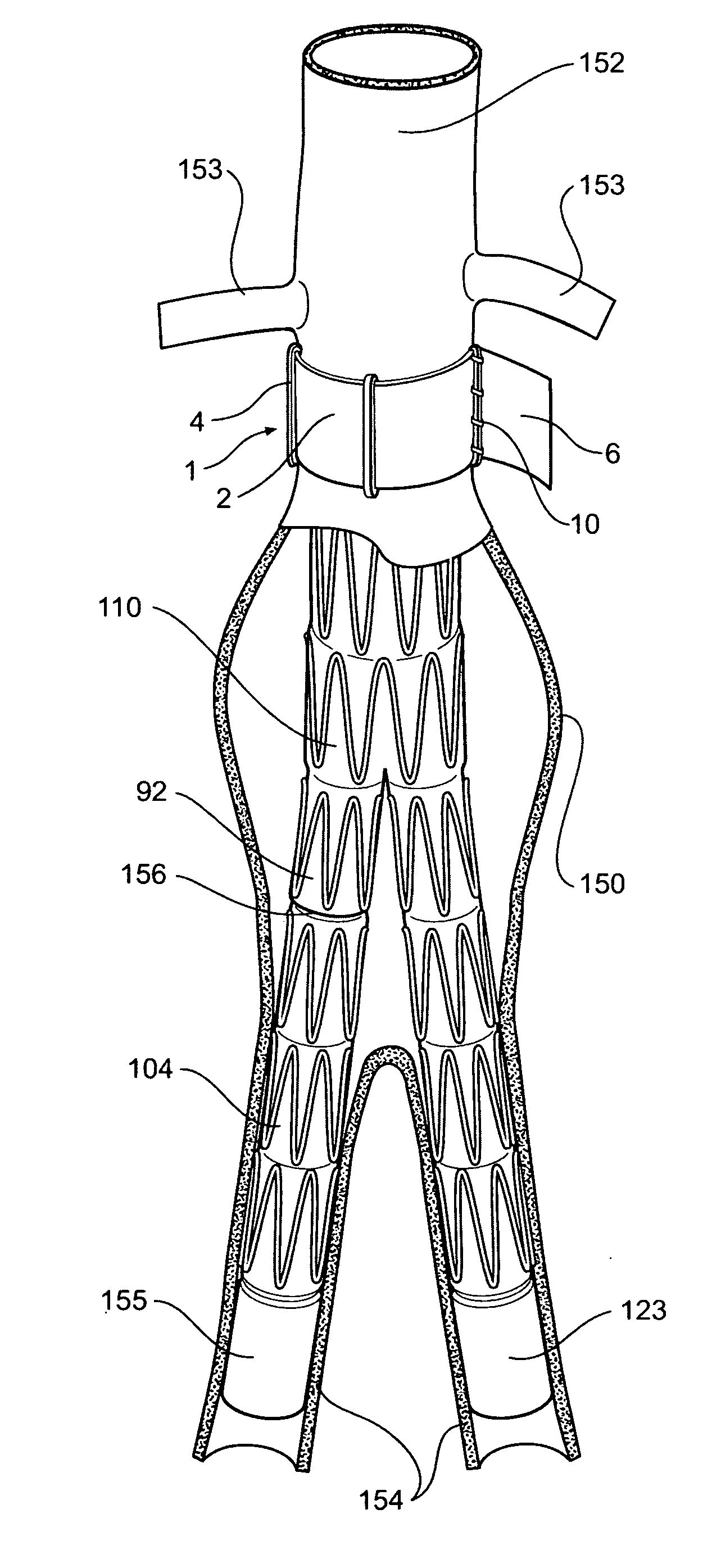 Vascular band