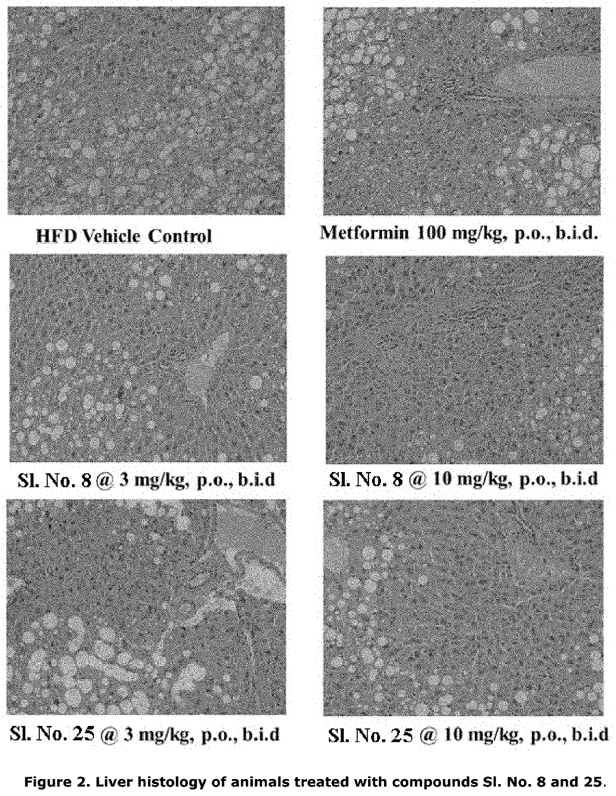 Method of treatment of non-alcoholic steatohepatitis, nash