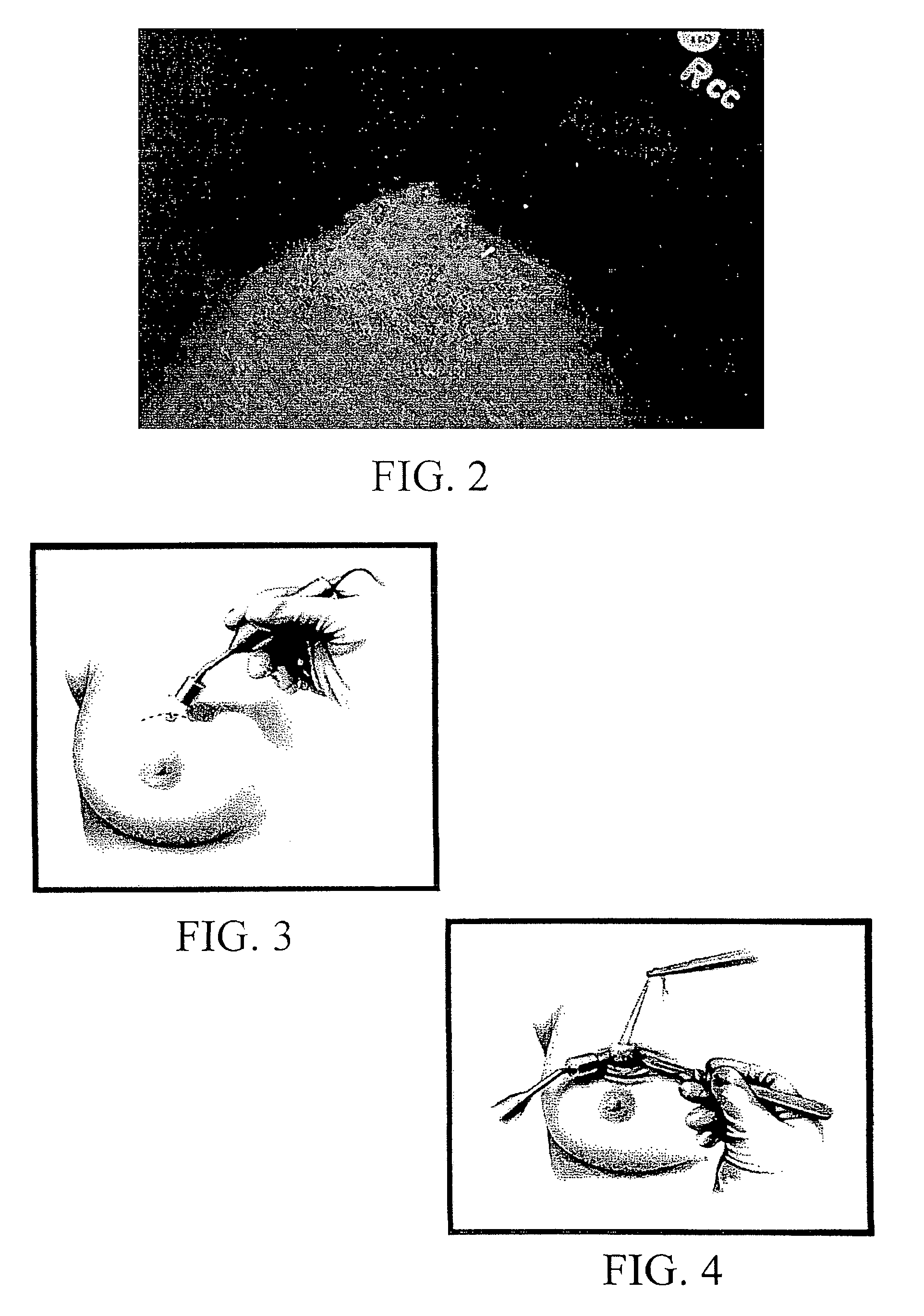 Radio guided seed localization of imaged lesions