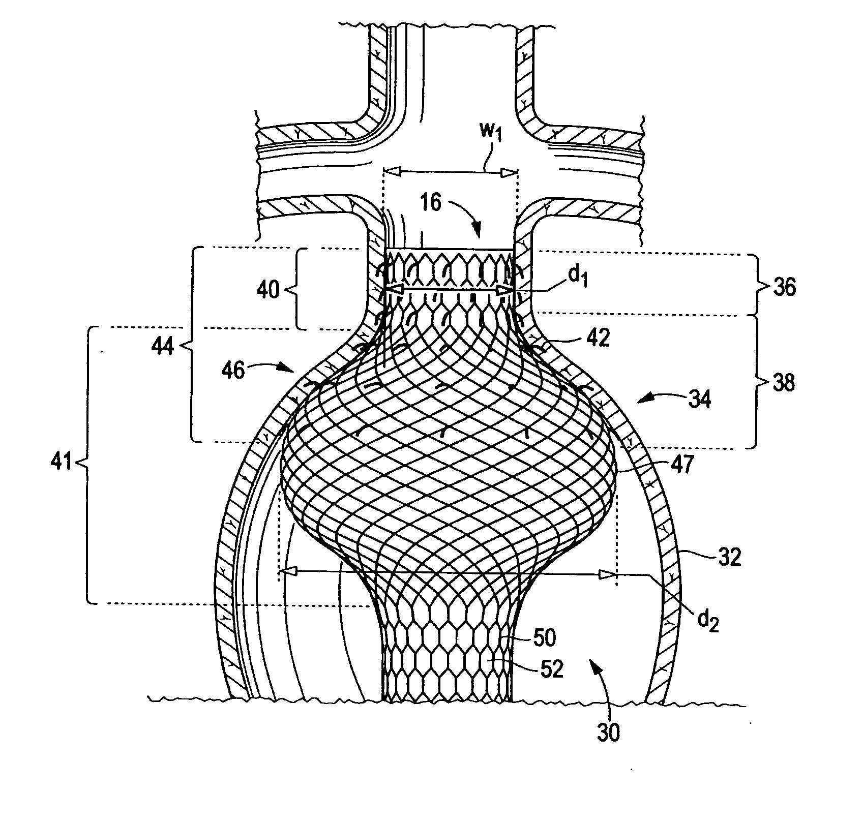 Endoluminal device having enhanced affixation characteristics