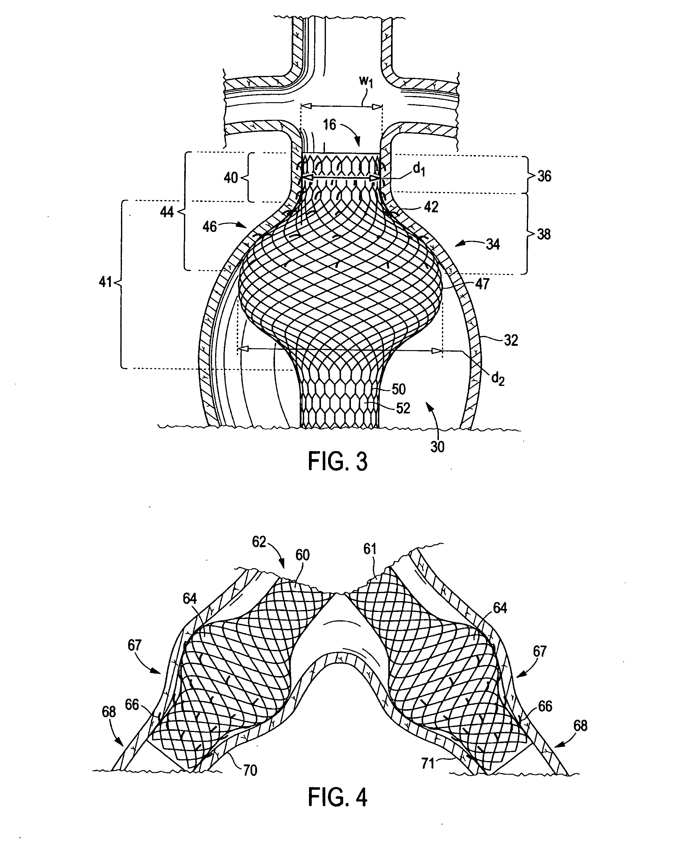 Endoluminal device having enhanced affixation characteristics