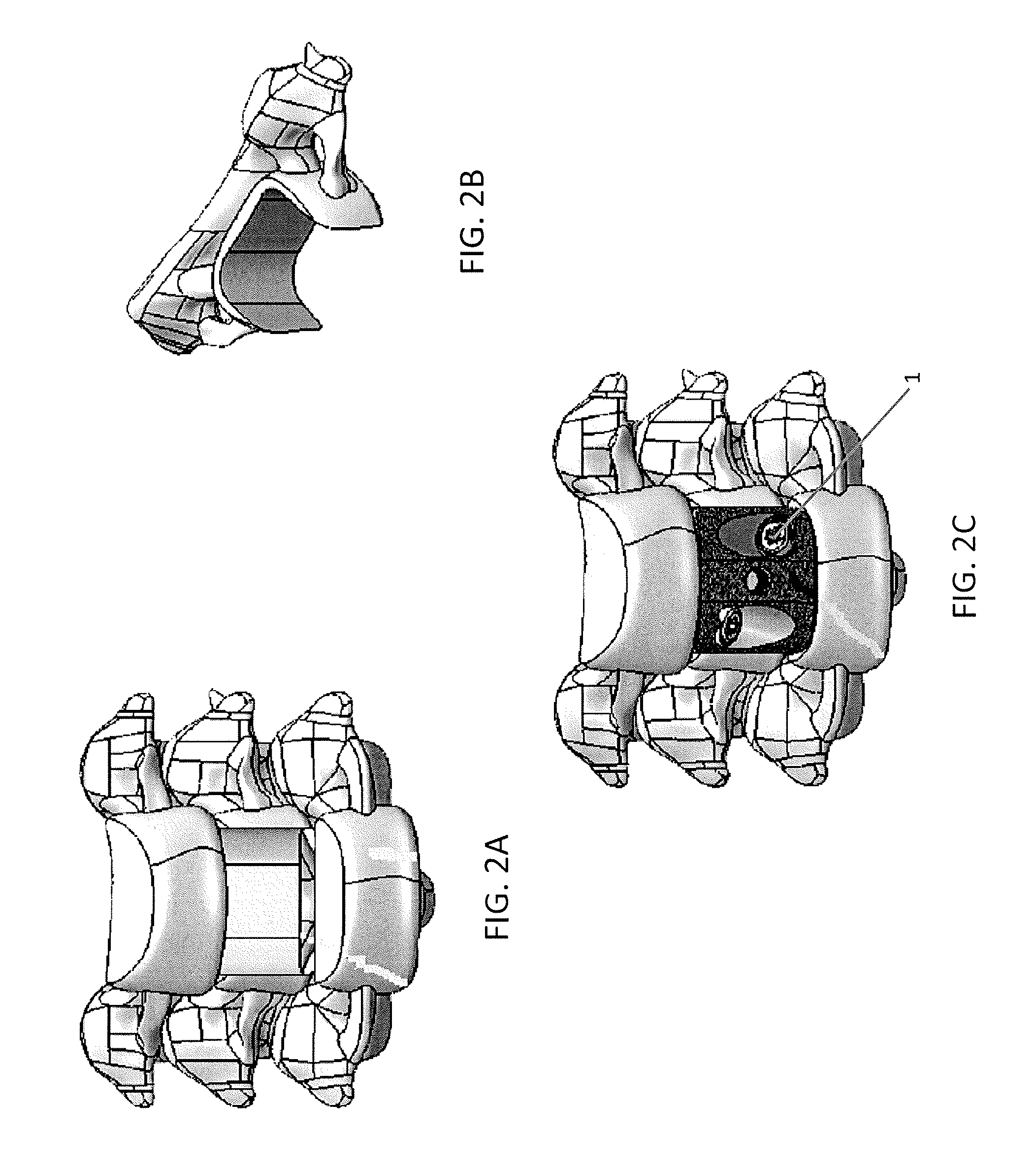 Corpectomy implants with roughened bioactive lateral surfaces