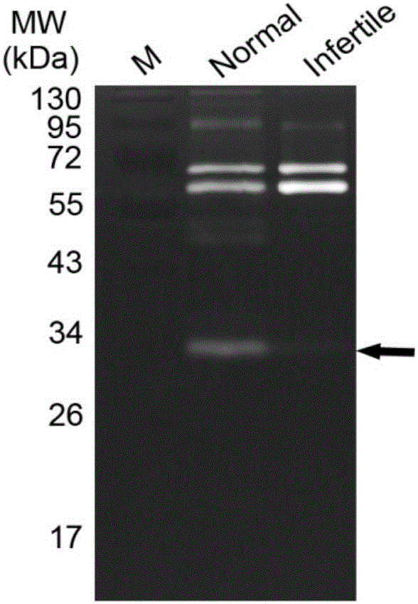 Prostate-specific antigen isomer, coding gene and application thereof