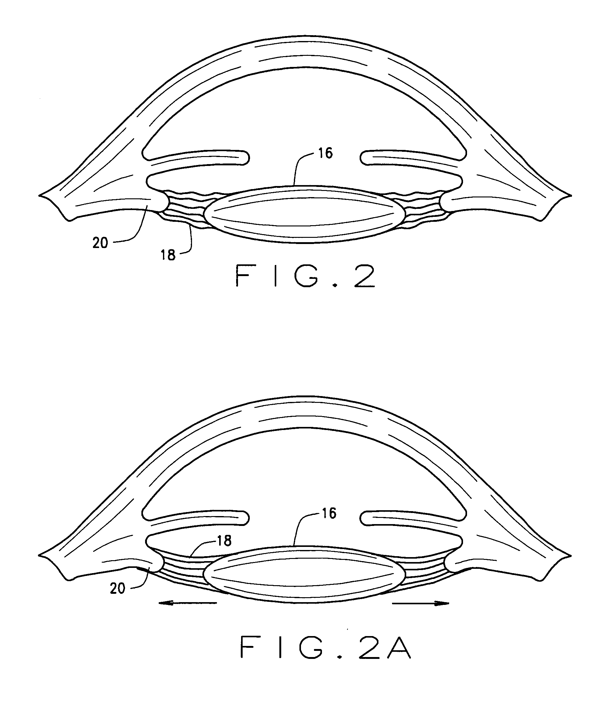 Ophthalmological zonular stretch segment for treating presbyopia