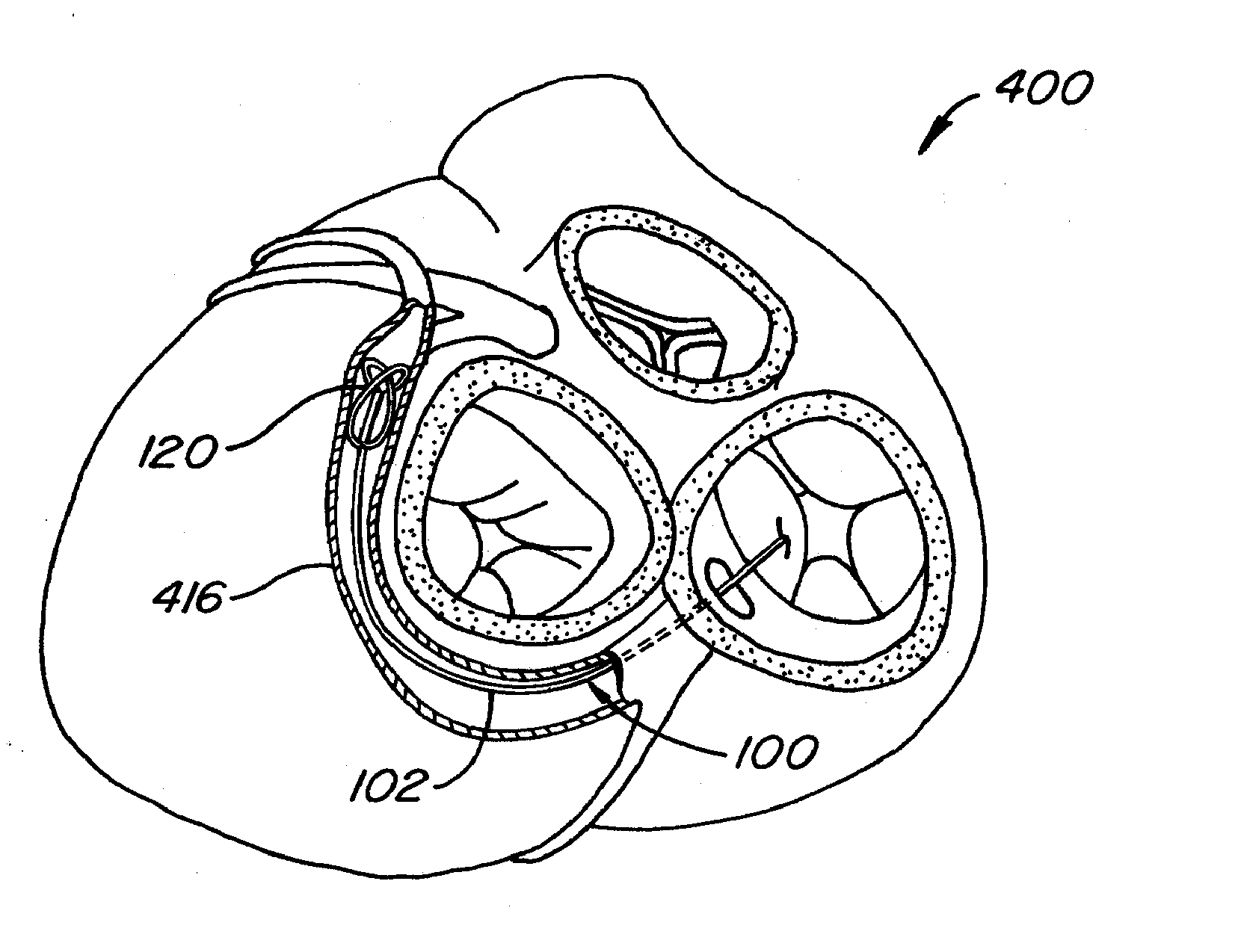 Mitral Valve Annuloplasty Device with Vena Cava Anchor