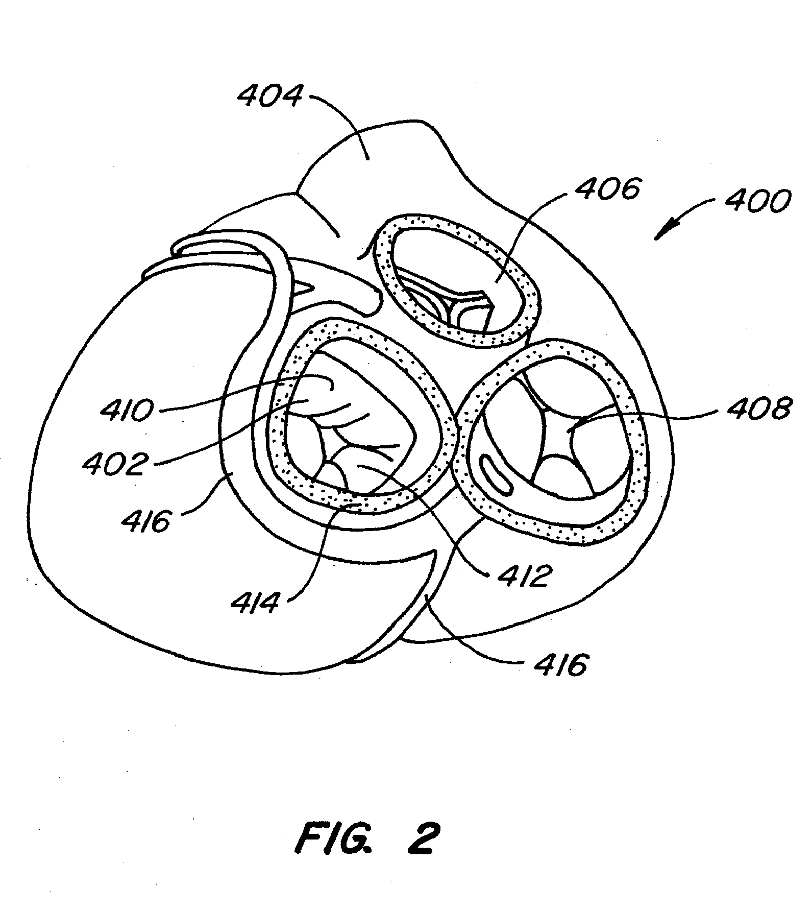 Mitral Valve Annuloplasty Device with Vena Cava Anchor