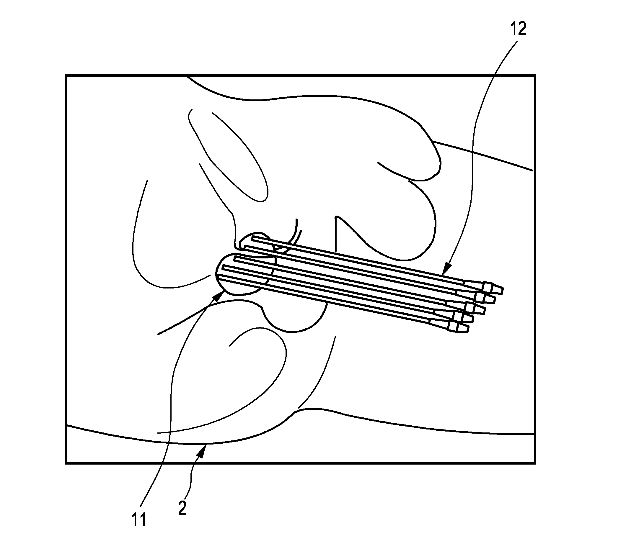 Brachytherapy apparatus