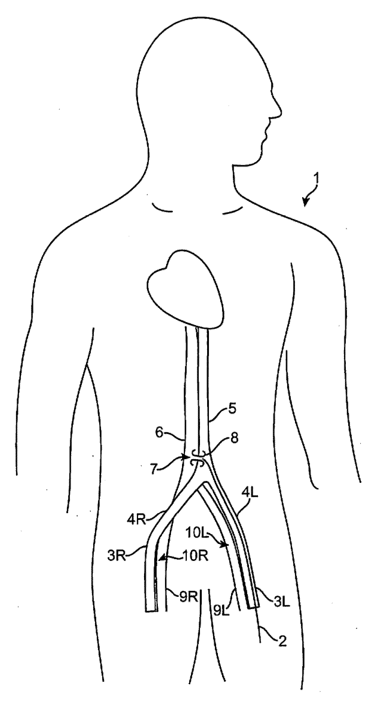 Device and method for establishing an artificial arterio-venous fistula