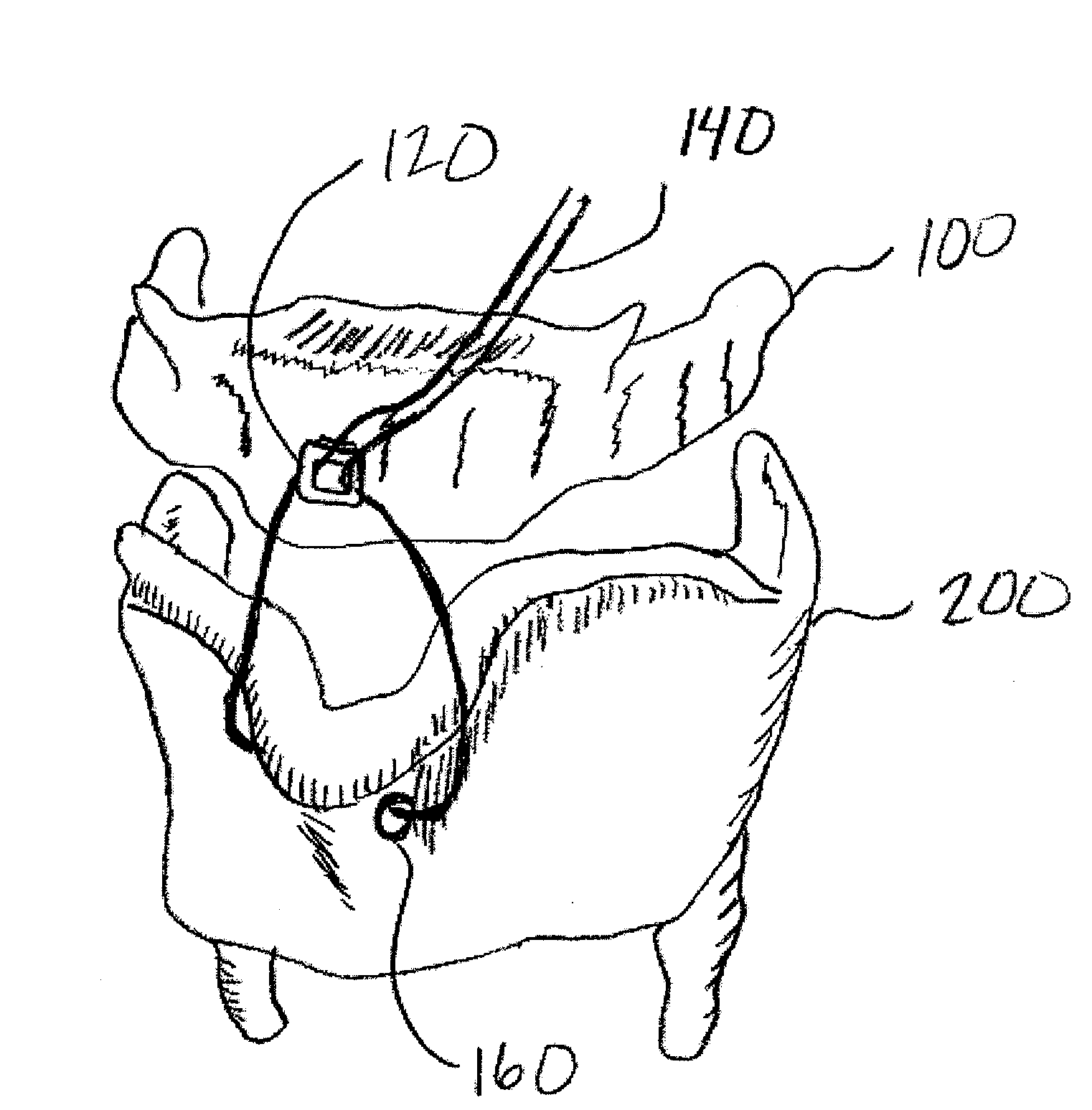 Method and system for displacing hyoid bone