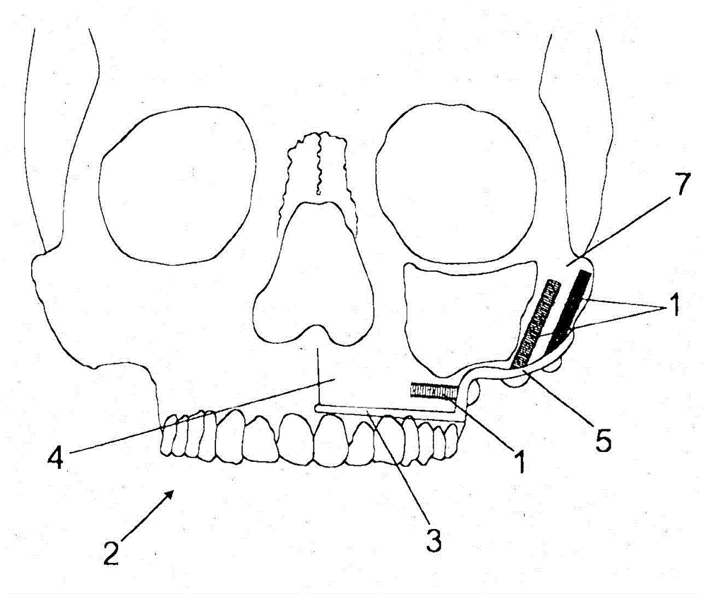 System for securing dental prosthesis