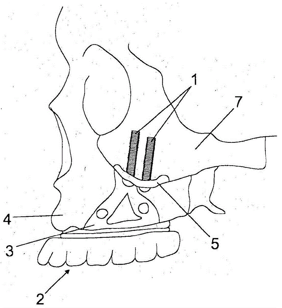 System for securing dental prosthesis