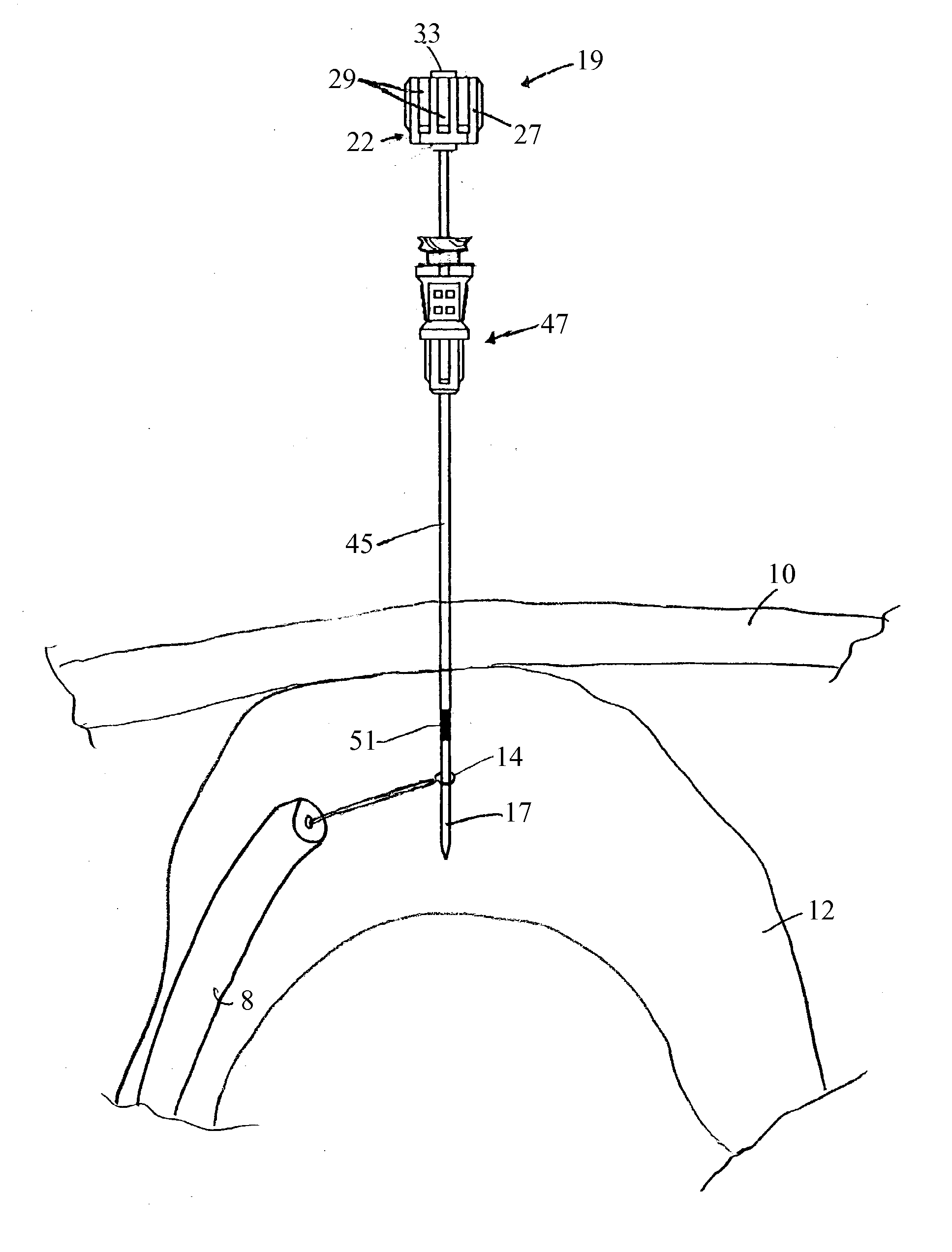 Method for implanting a percutaneous endoscopic gastrostomy/jejunostomy tube in a patient and access needle for use in said method