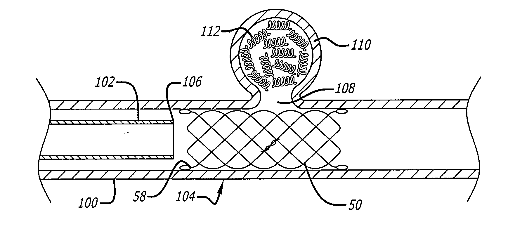 Self-expanding pseudo-braided intravascular device