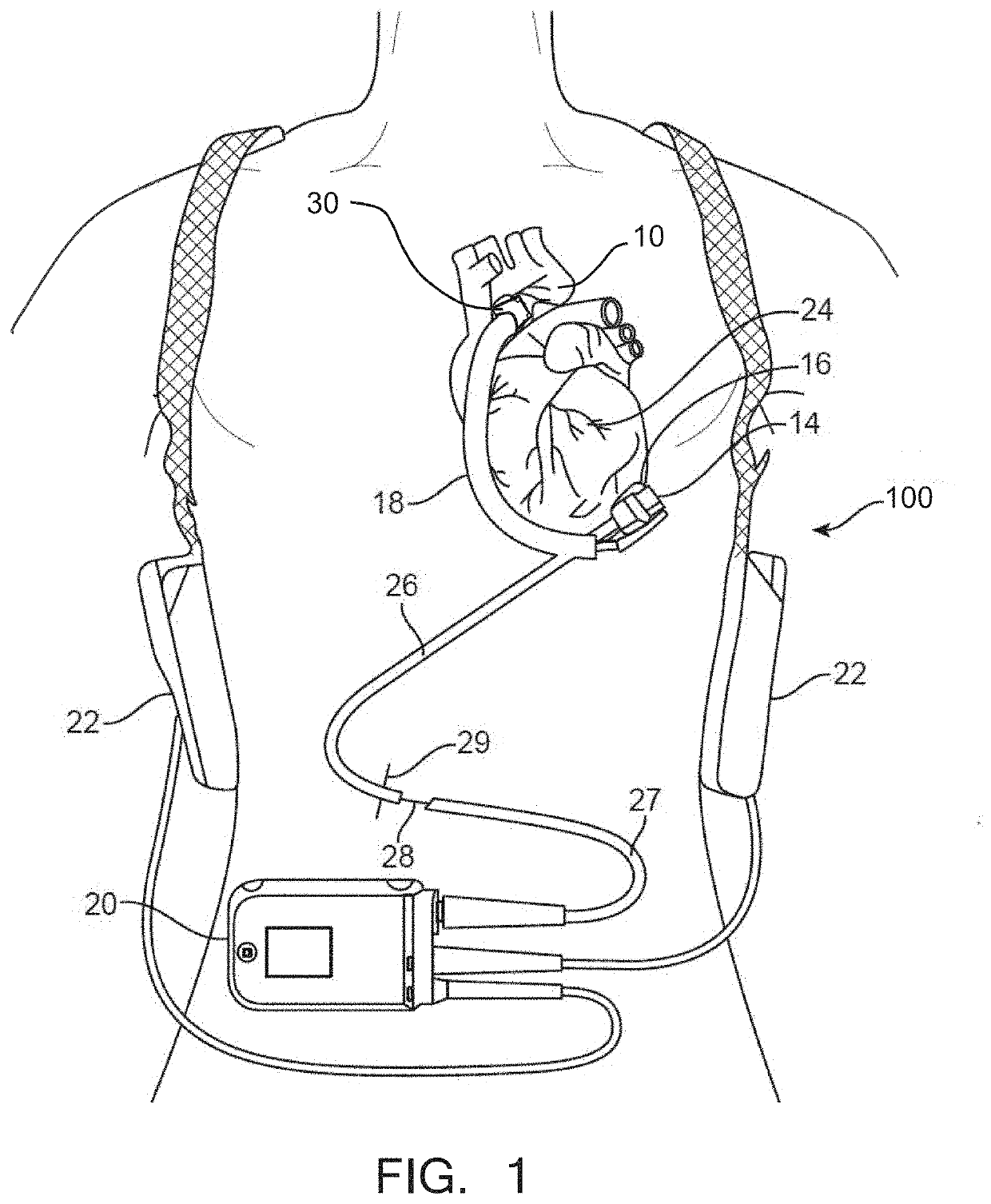 Aortic connectors and methods of use