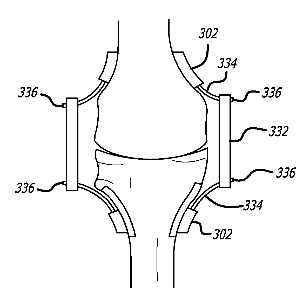 Extra-Articular Implantable Mechanical Energy Absorbing Systems