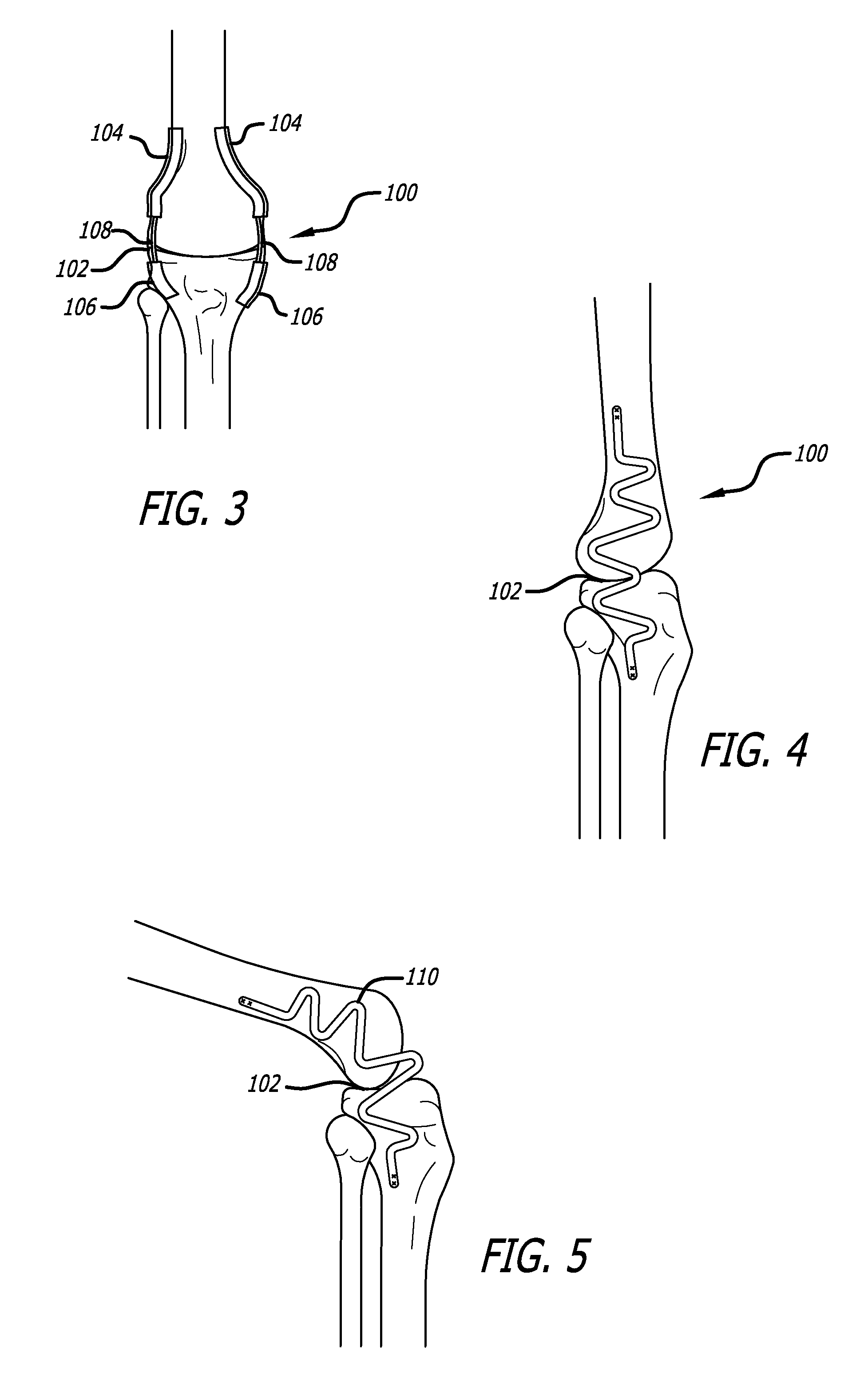 Extra-Articular Implantable Mechanical Energy Absorbing Systems