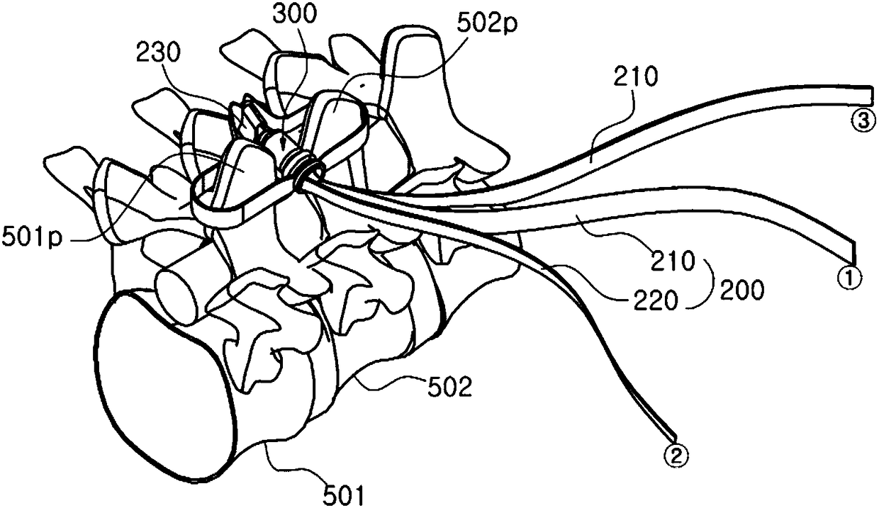 Spacer device for fixing band between spinous processes