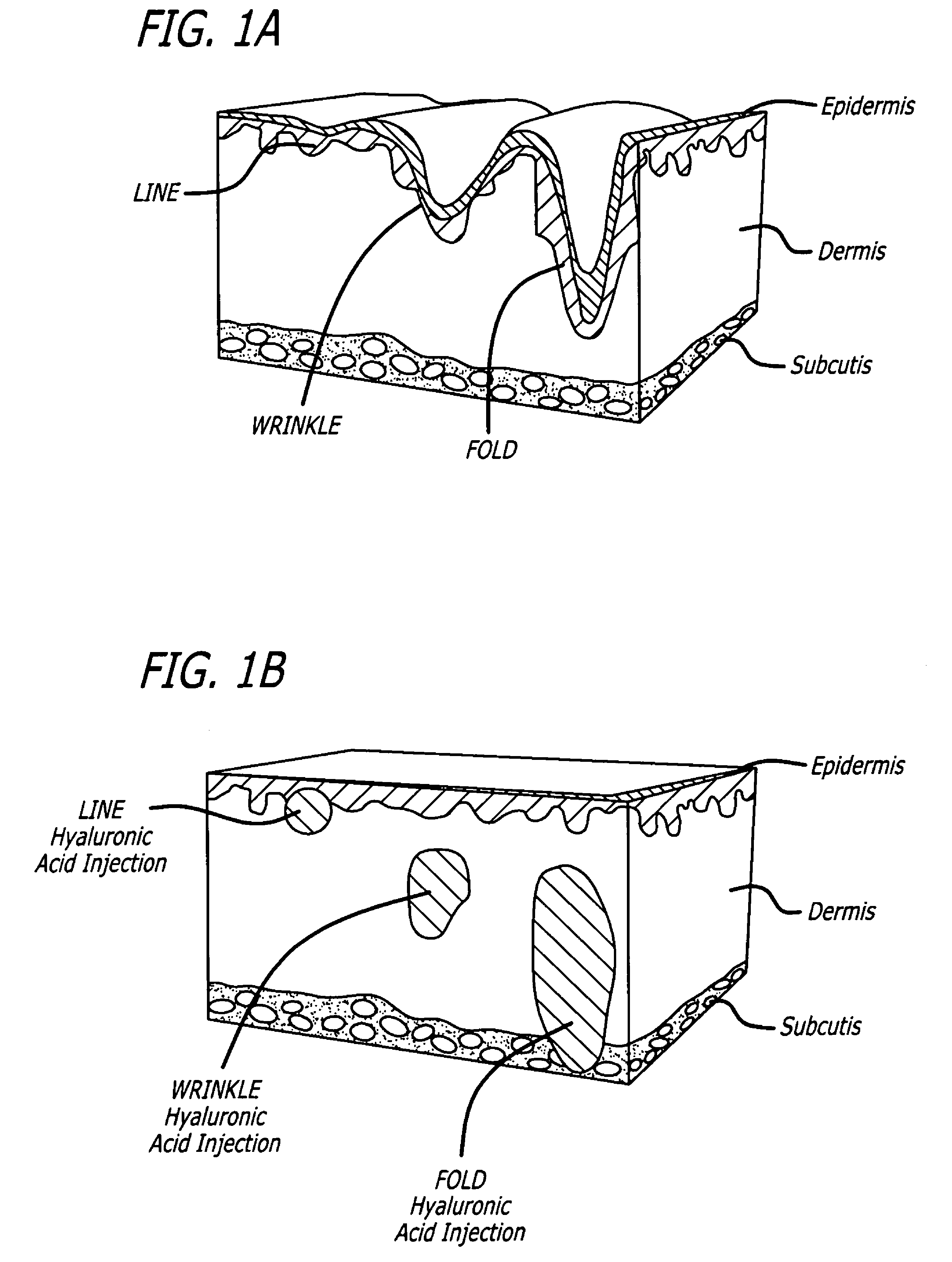 Soft tissue augmentation by needle-free injection