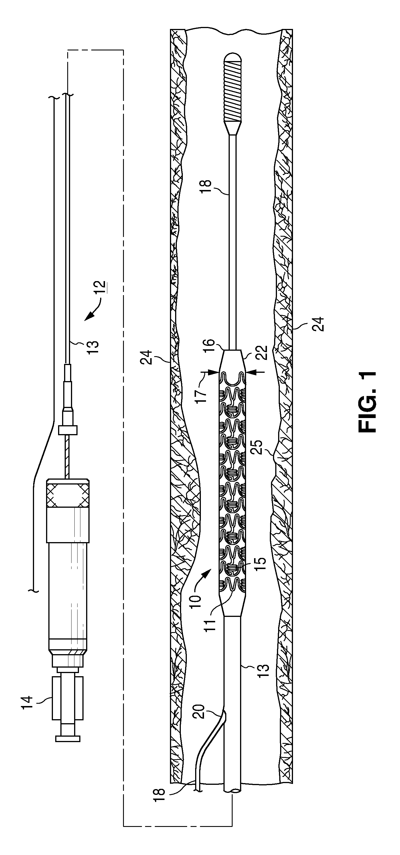 Treatment of diabetic patients with a stent and locally administered adjunctive therapy