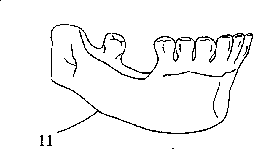 Method for produce digital tooth implantation planning auxiliary assembly