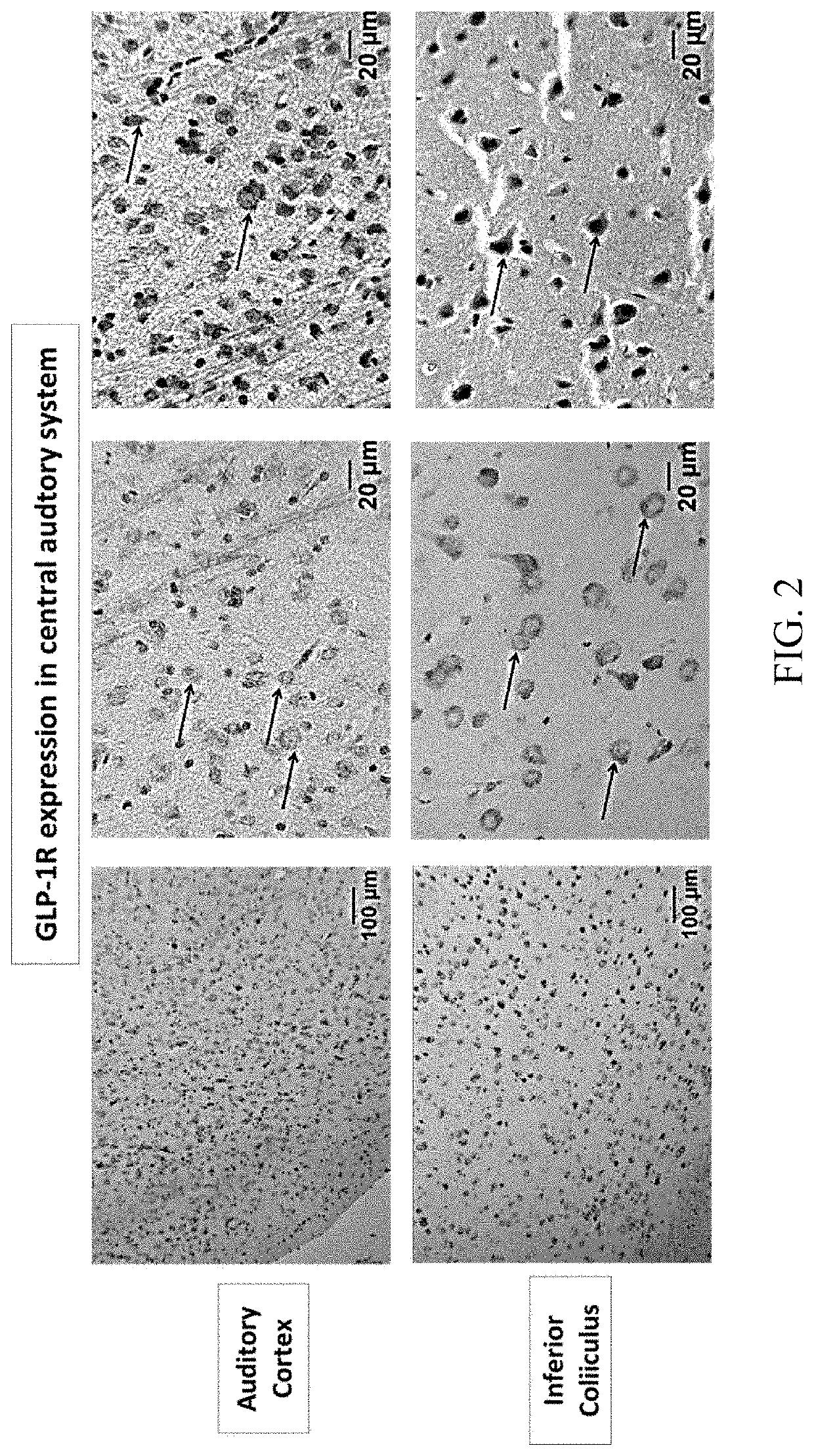 Uses of glucagon-like peptide-1 receptor agonists for treating trauma-induced hearing loss